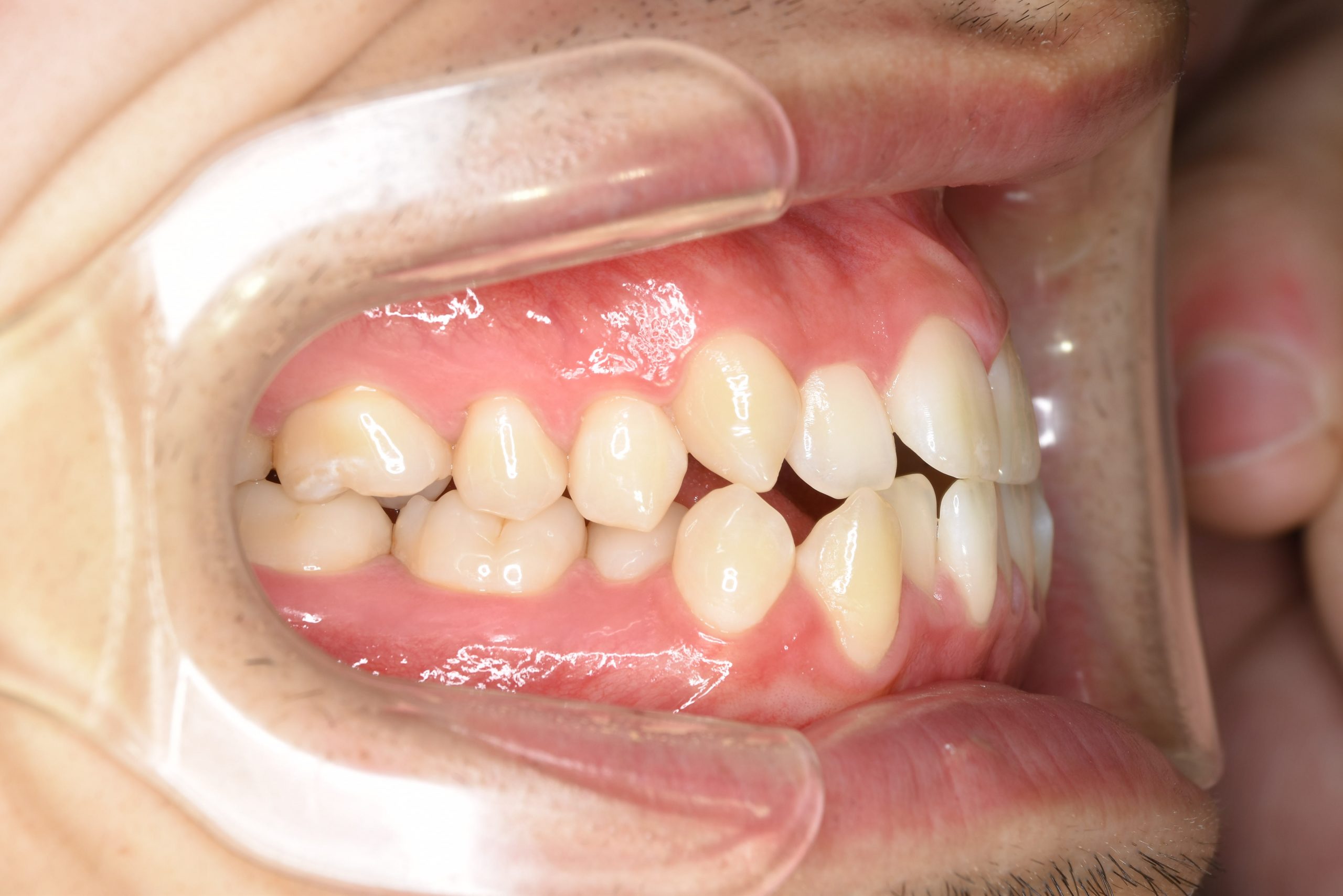 全顎ワイヤー矯正　症例_495