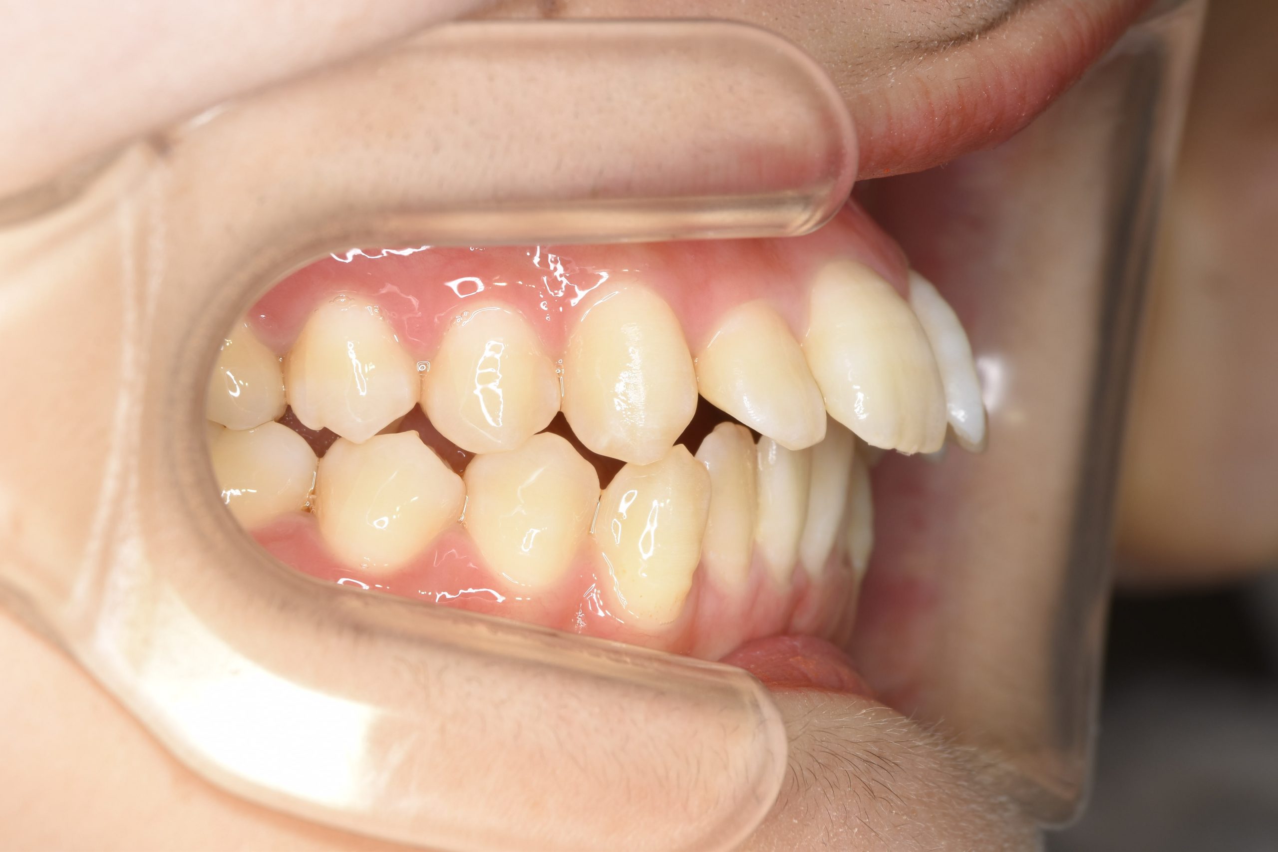 全顎ワイヤー矯正　症例_500