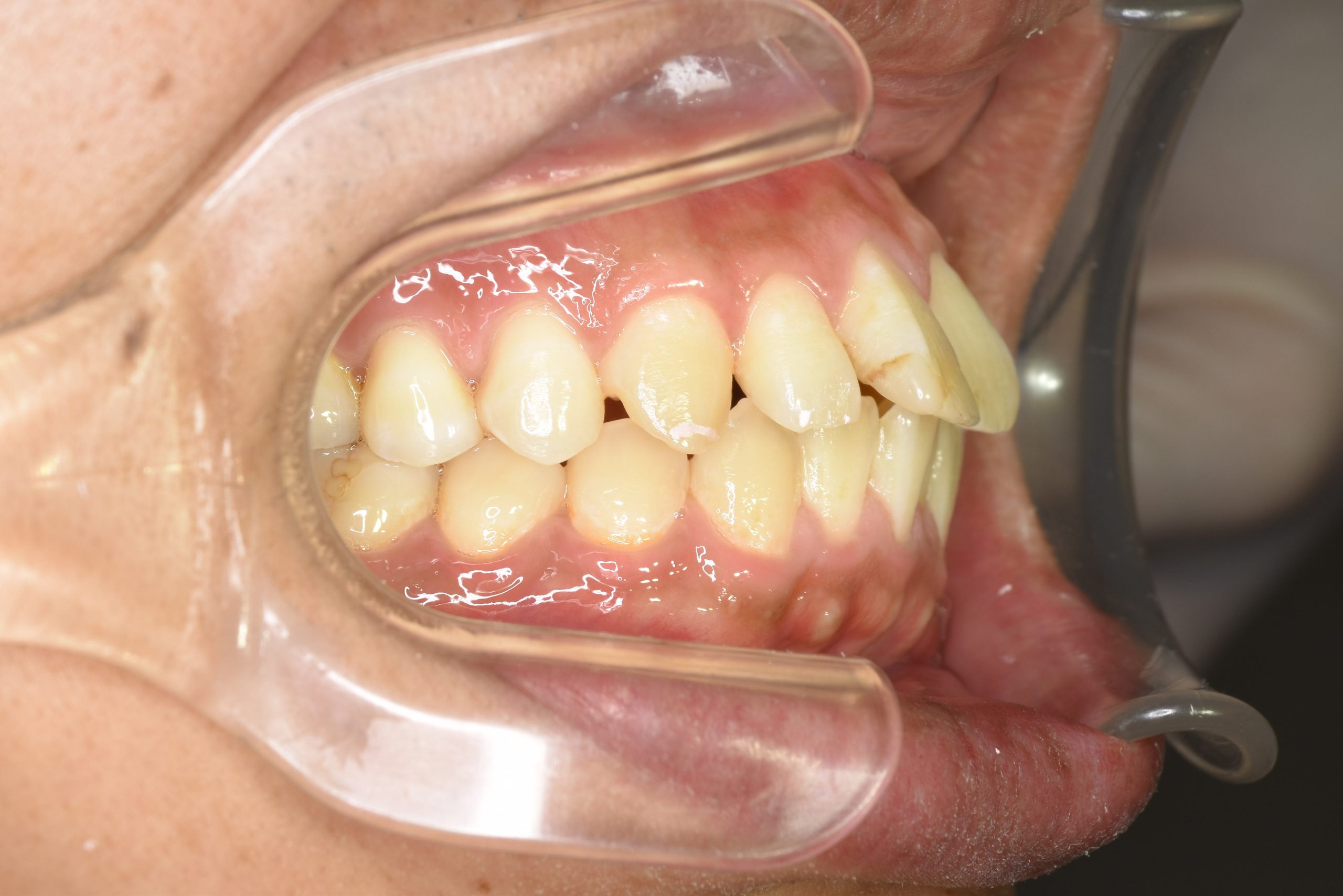 全顎ワイヤー矯正　症例_510