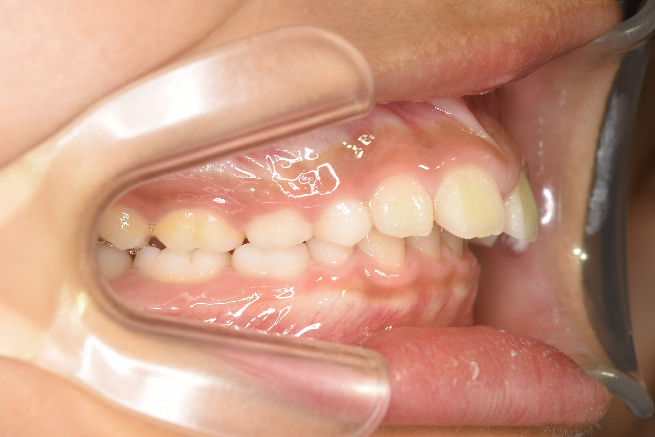 全顎ワイヤー矯正　症例_547