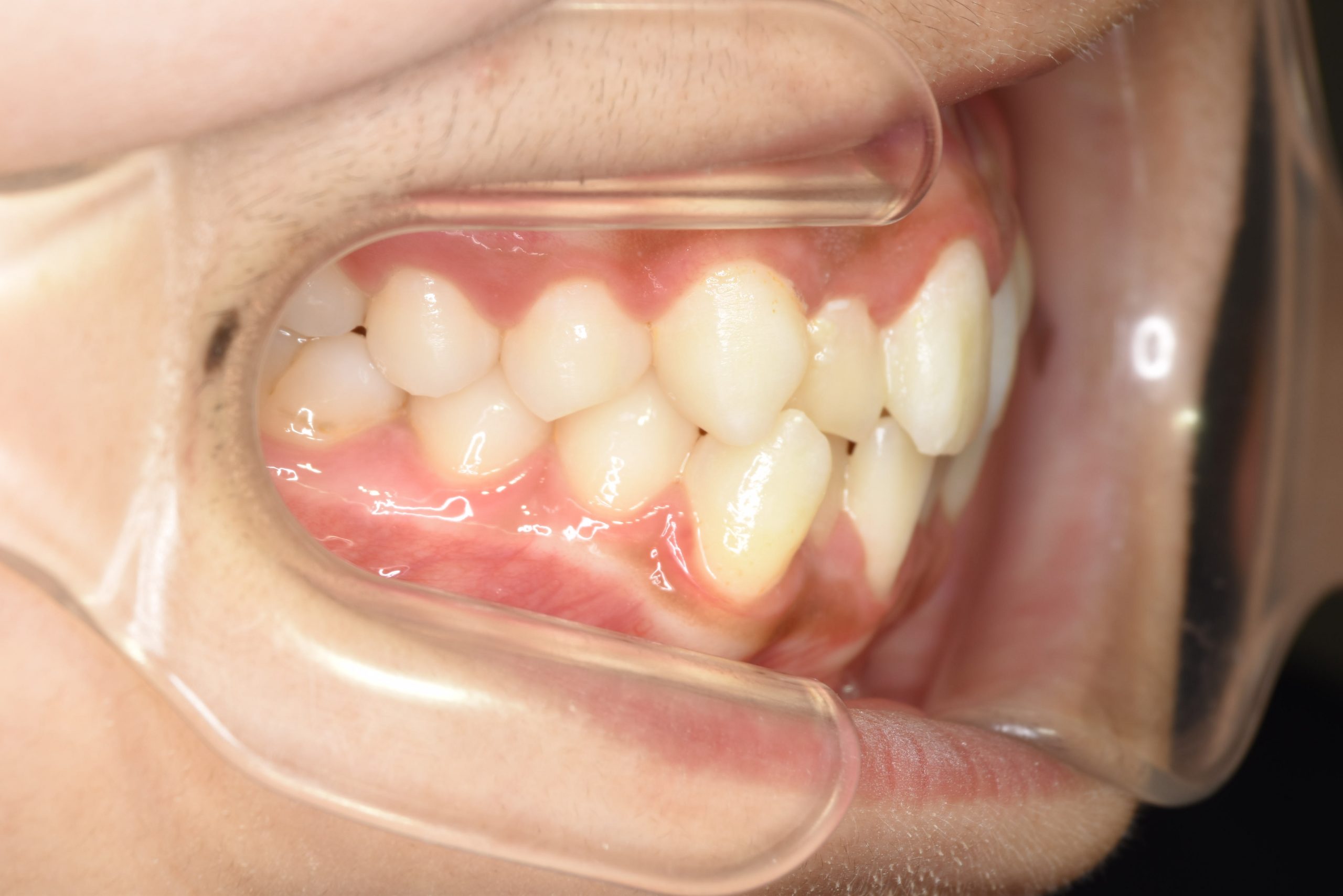 全顎ワイヤー矯正　症例_551