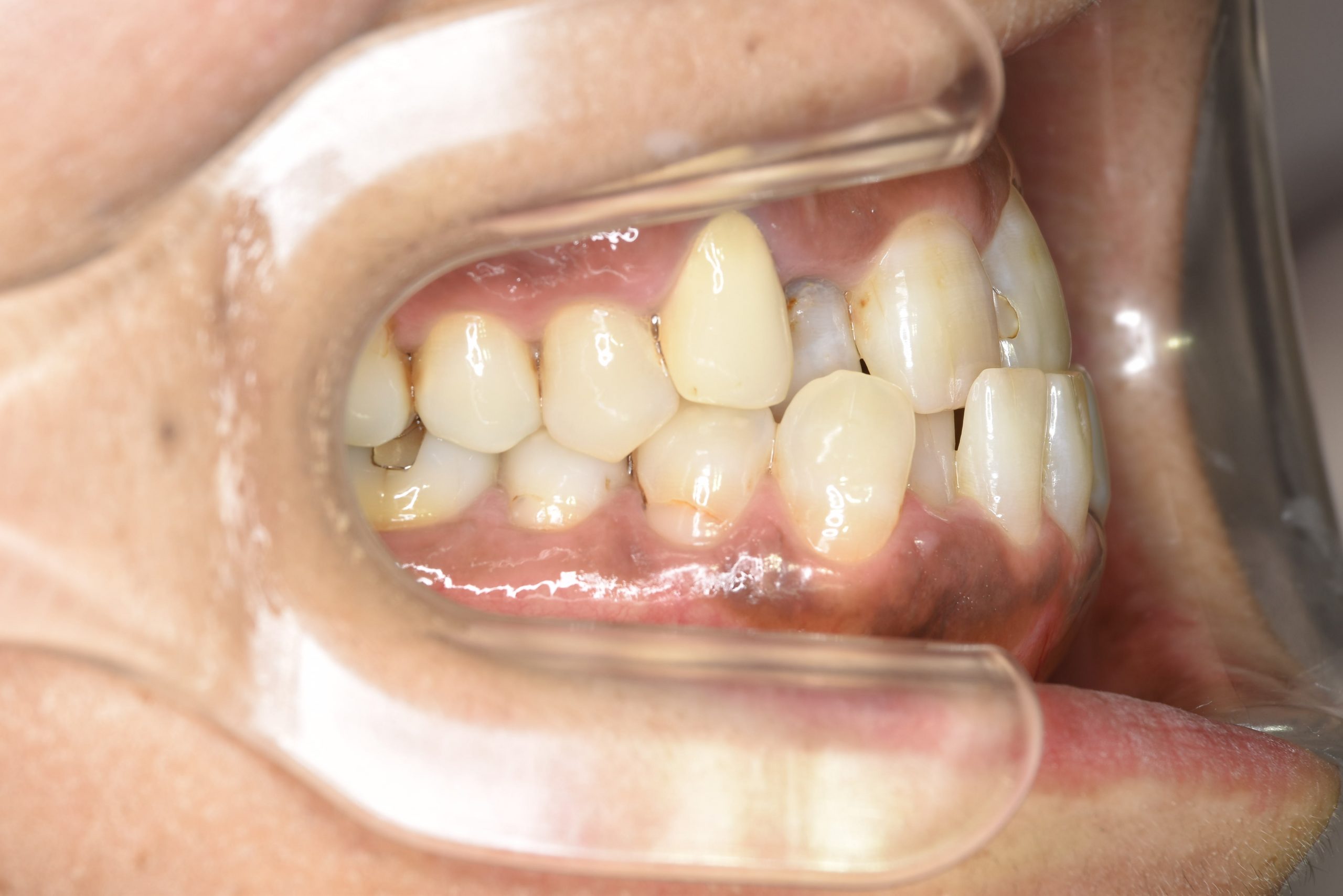 全顎ワイヤー矯正　症例_588