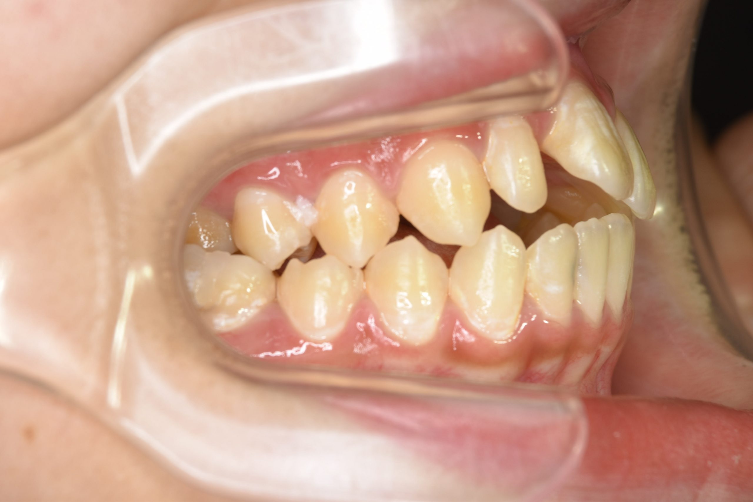 全顎ワイヤー矯正　症例_640