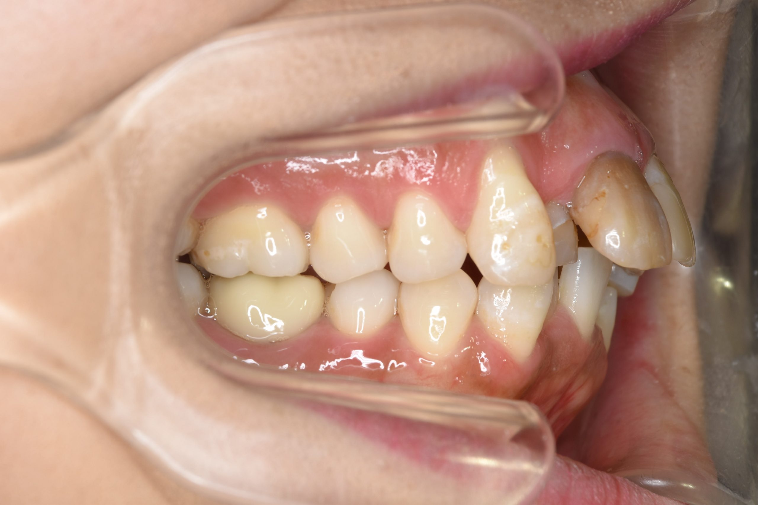 全顎ワイヤー矯正　症例_649