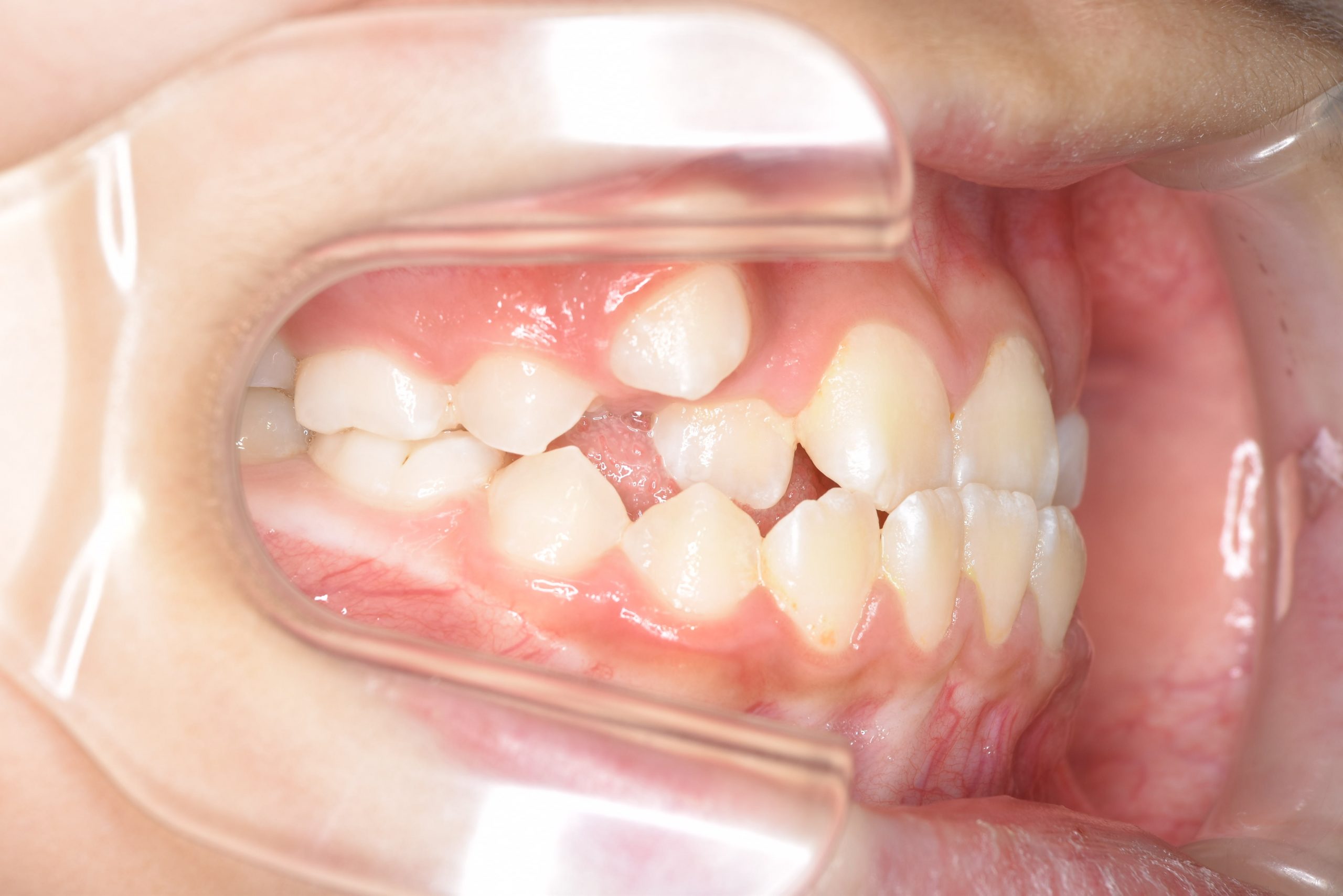 全顎ワイヤー矯正　症例_139