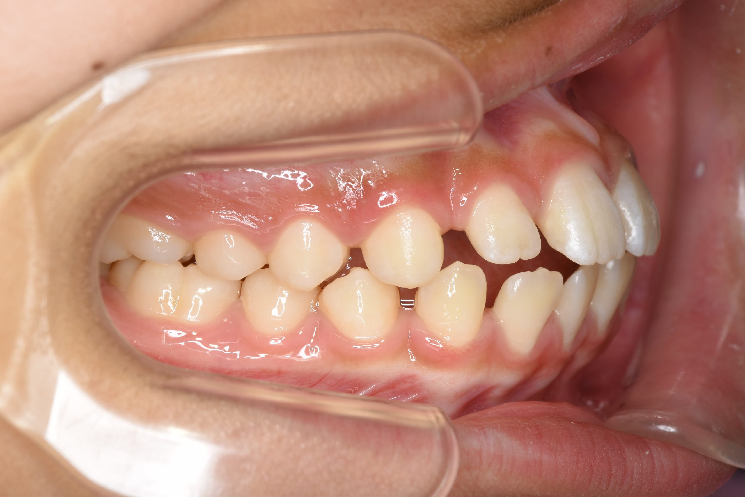 全顎ワイヤー矯正　症例_681