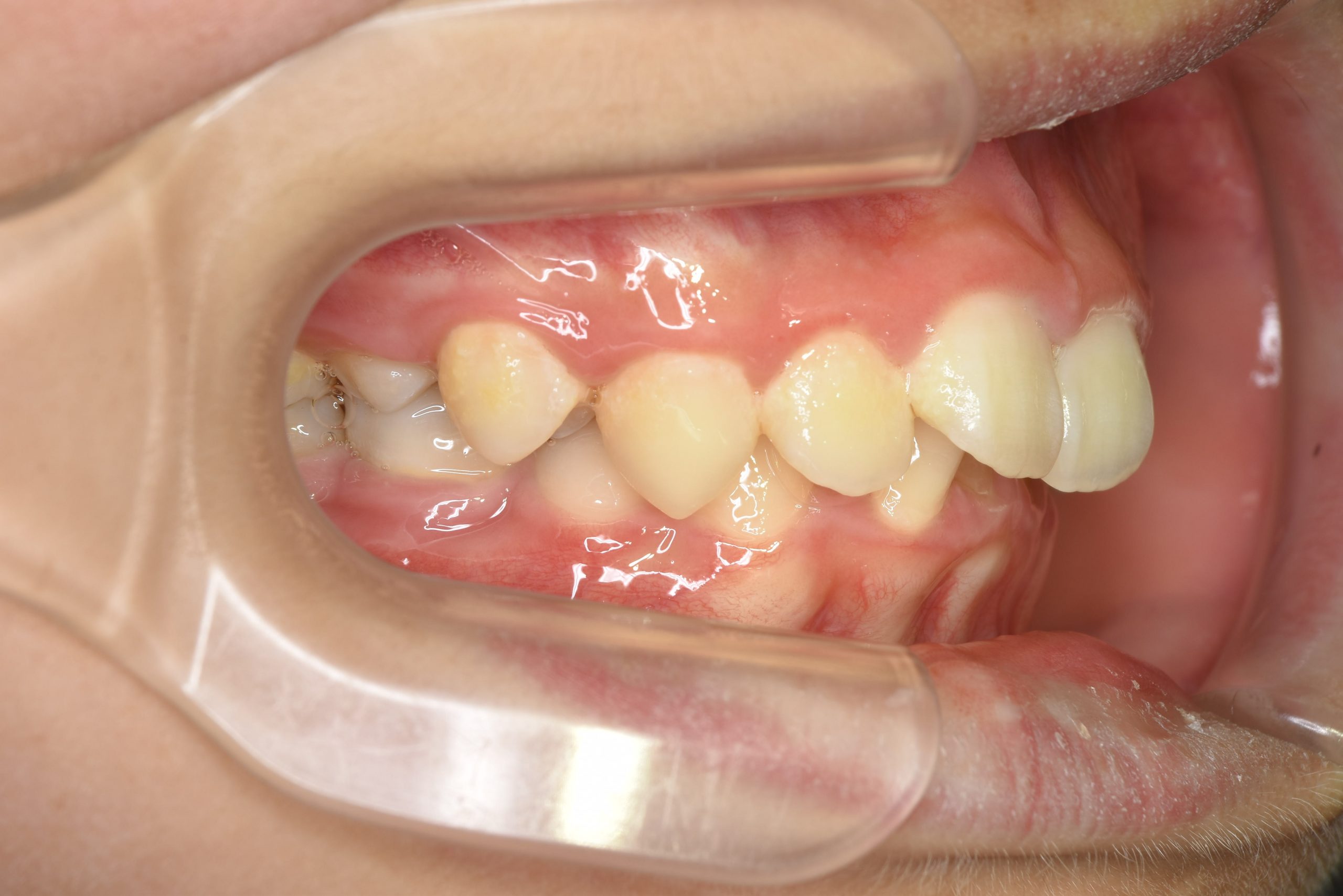 全顎ワイヤー矯正　症例_758