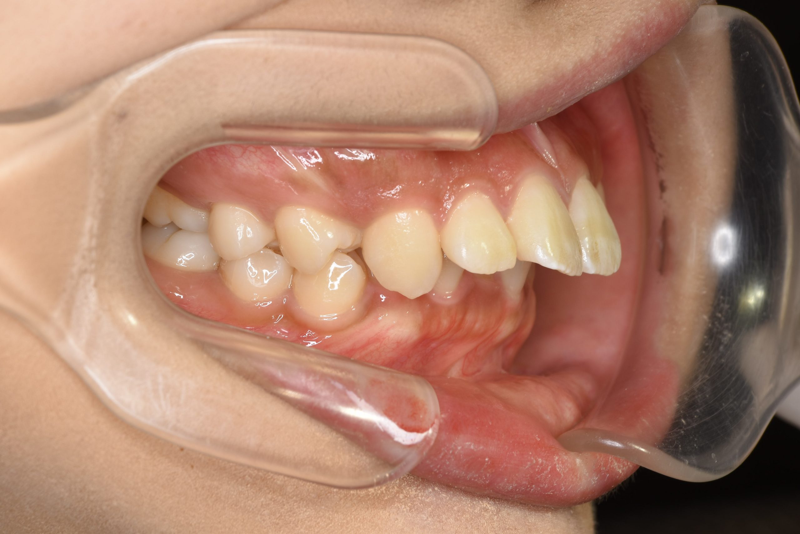 全顎ワイヤー矯正　症例_793