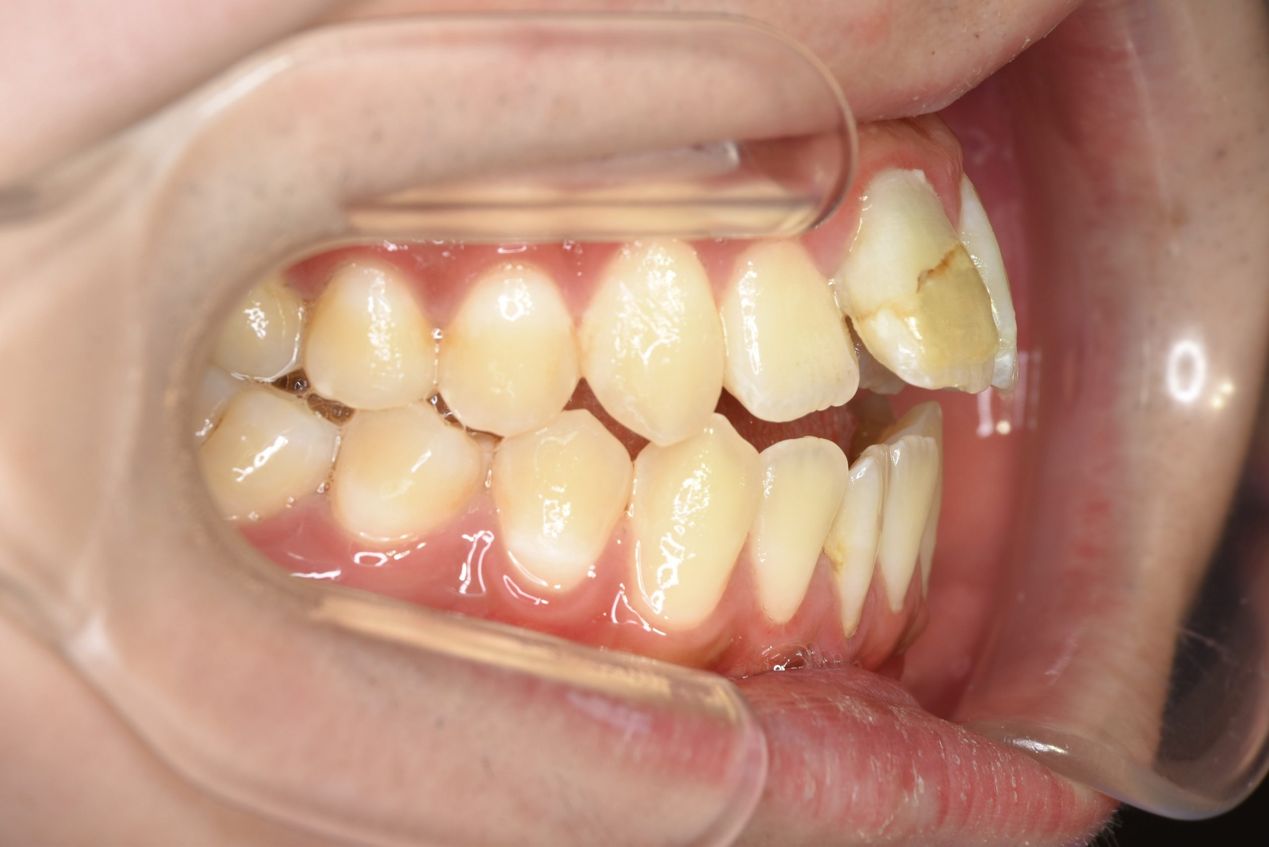 全顎ワイヤー矯正　症例_798