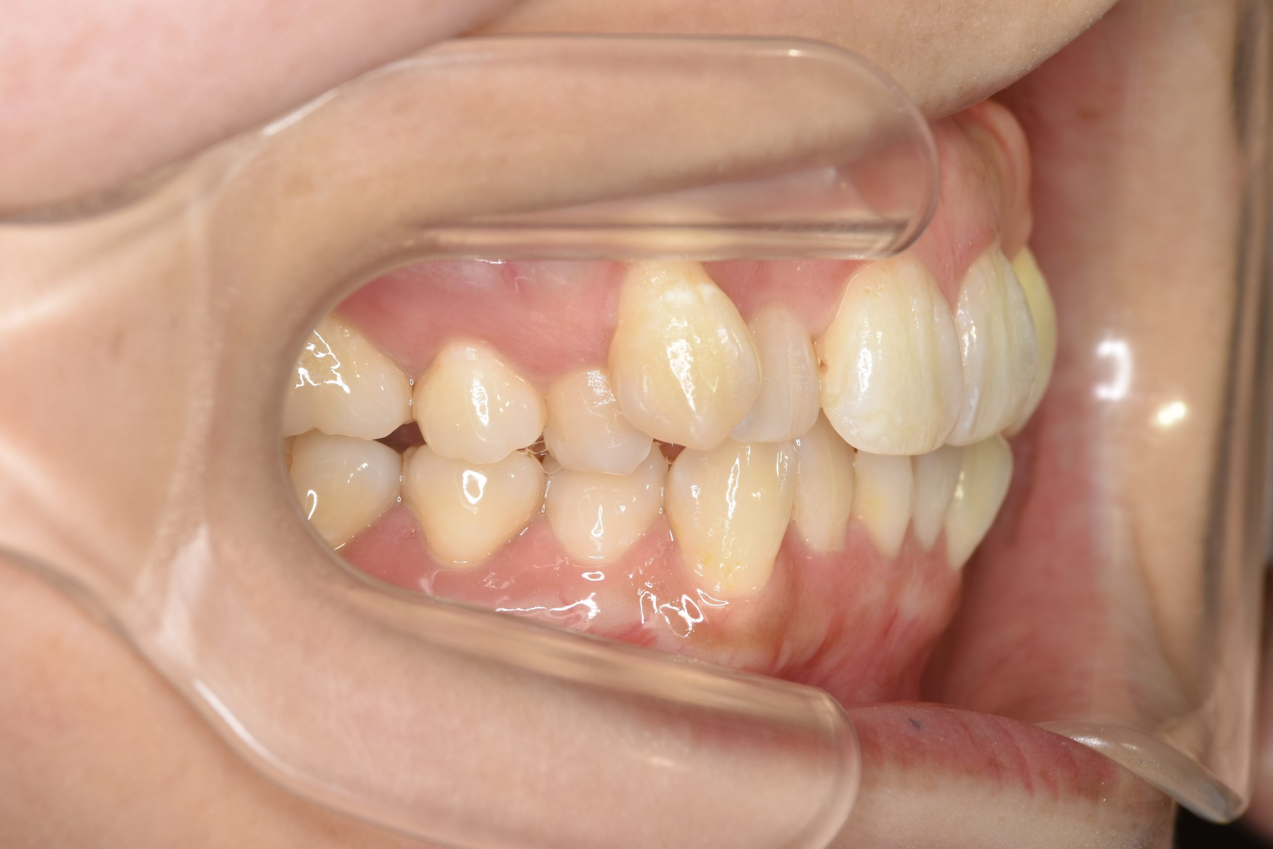 全顎ワイヤー矯正　症例_814