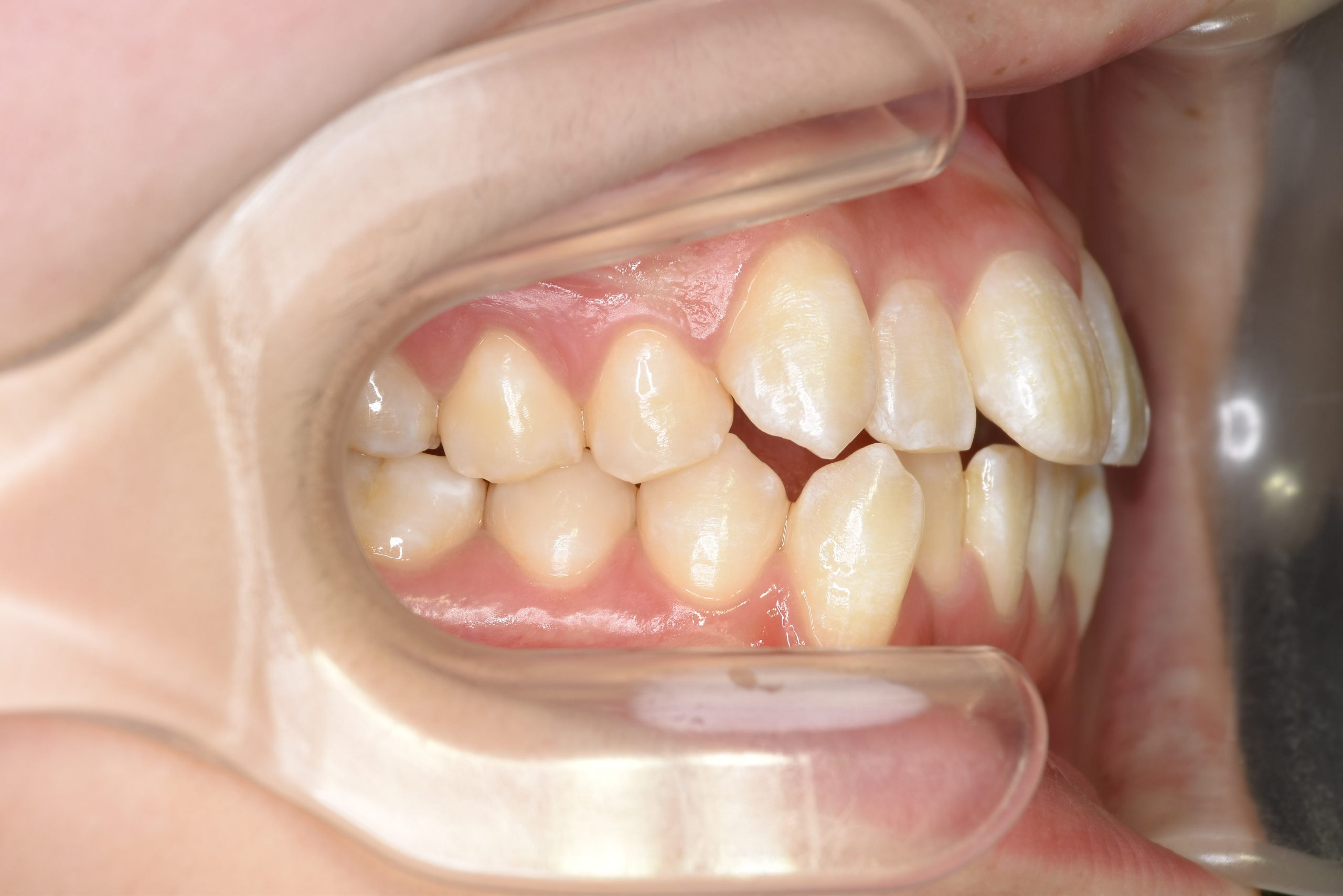 全顎ワイヤー矯正　症例_815