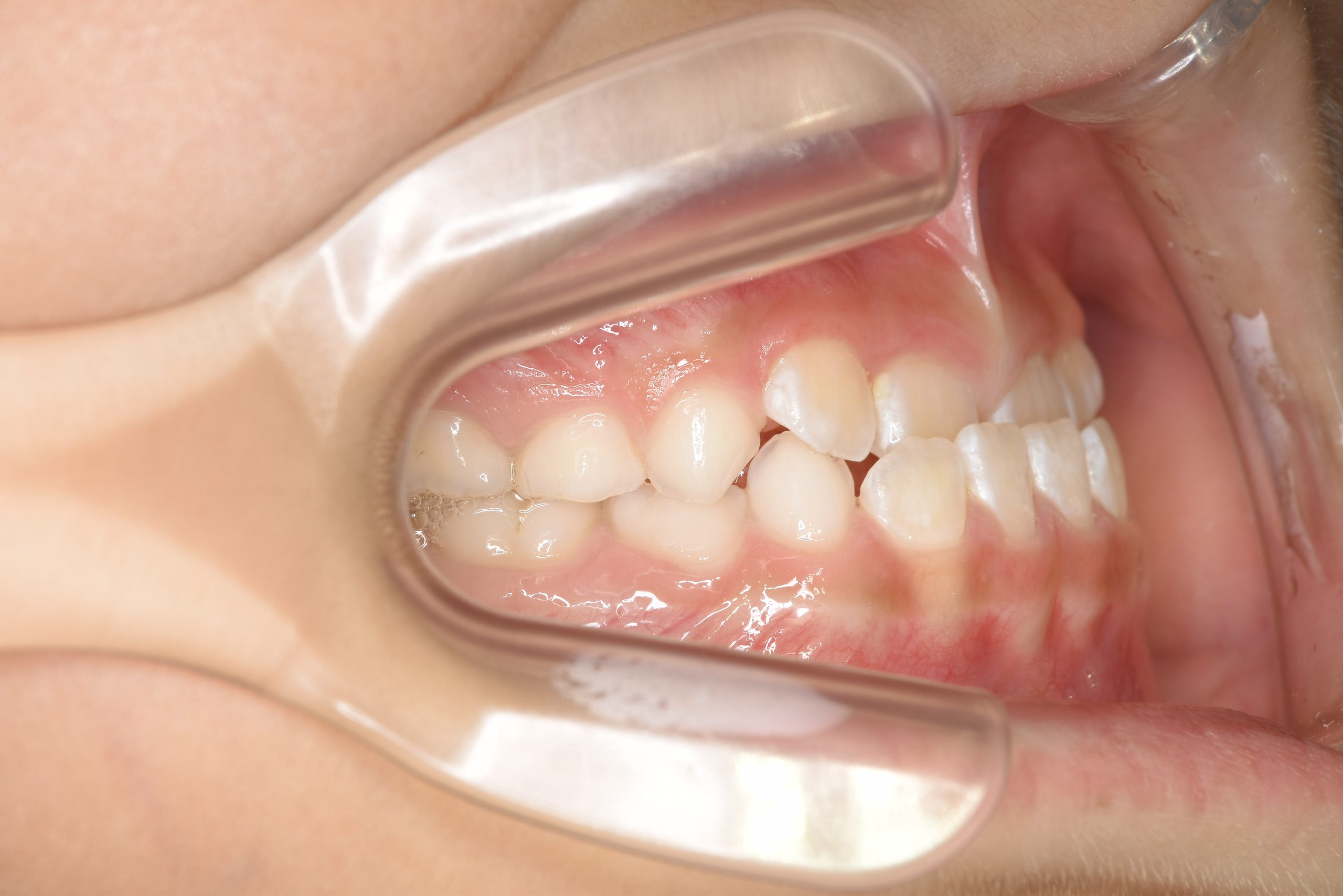 全顎ワイヤー矯正　症例_858