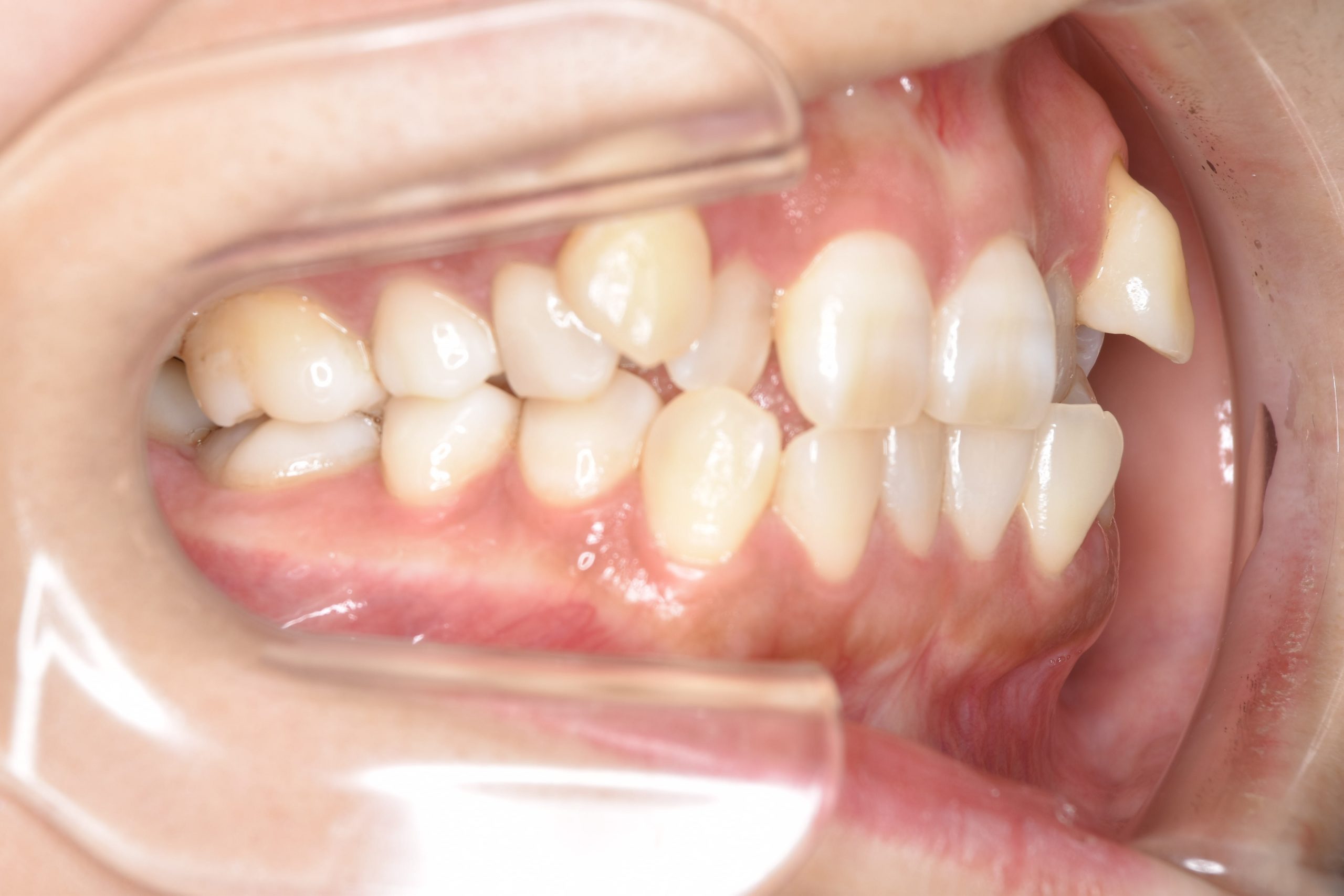 全顎ワイヤー矯正　症例_141