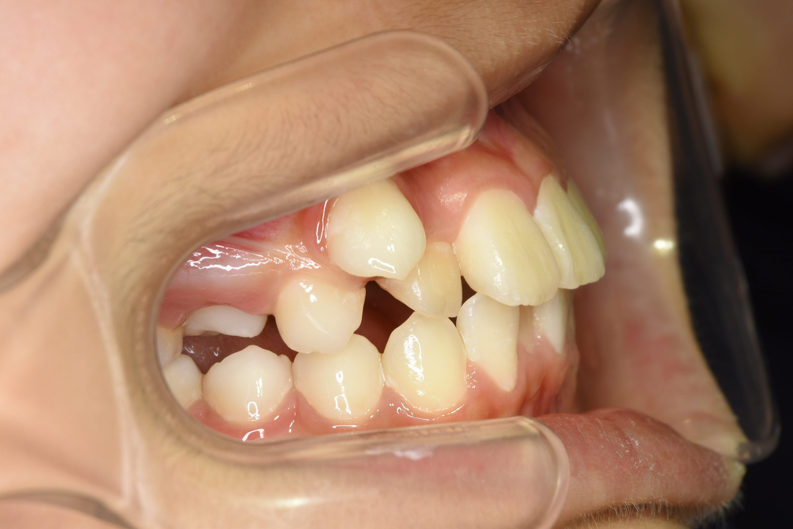 全顎ワイヤー矯正　症例_1324