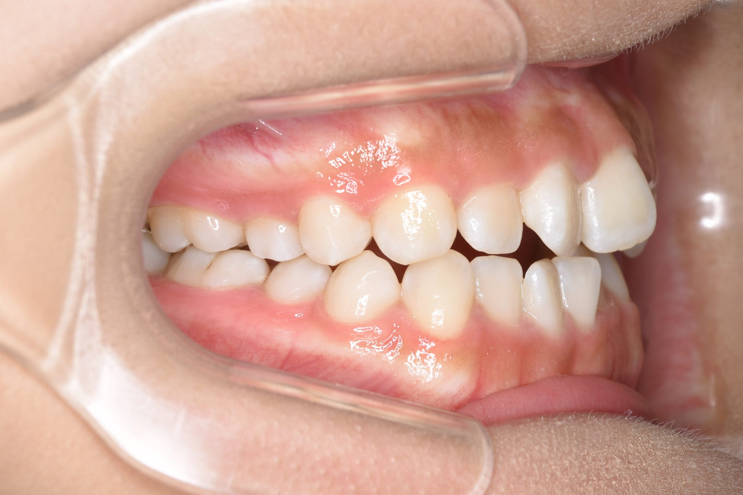 全顎ワイヤー矯正　症例_148