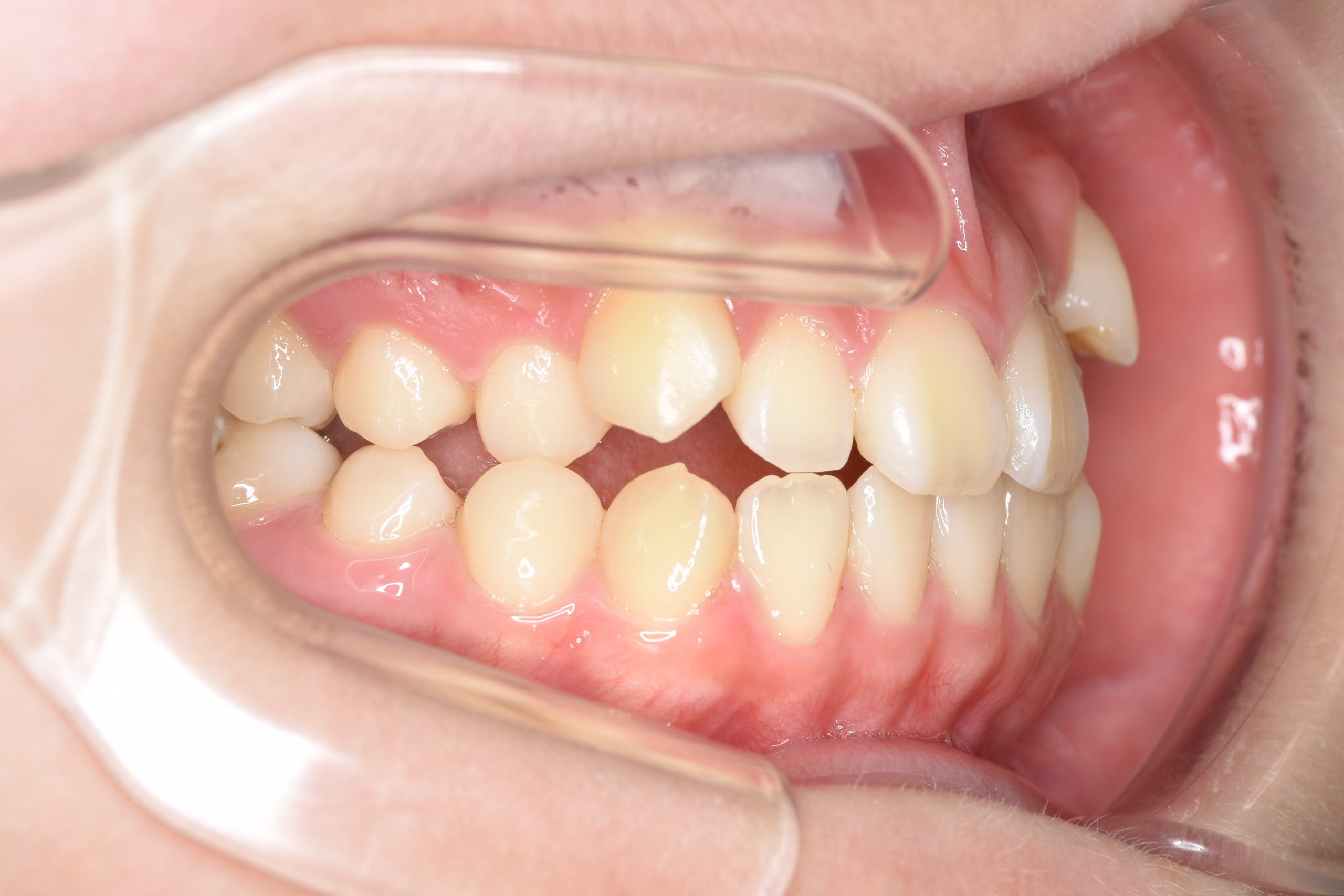 全顎ワイヤー矯正　症例_154