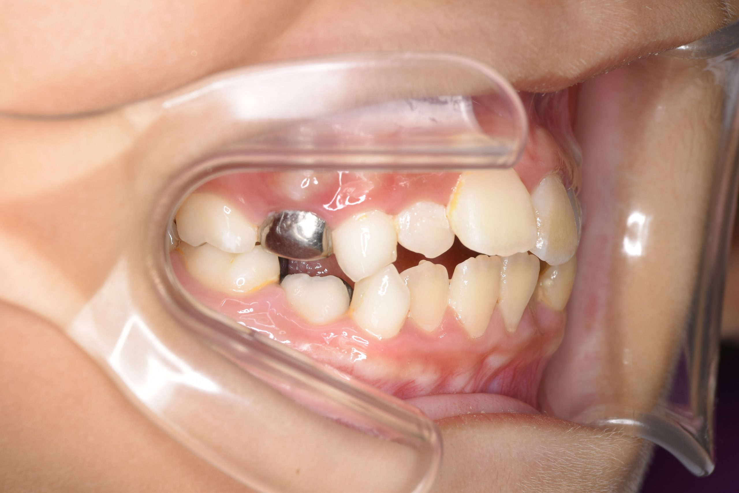 全顎ワイヤー矯正　症例_169