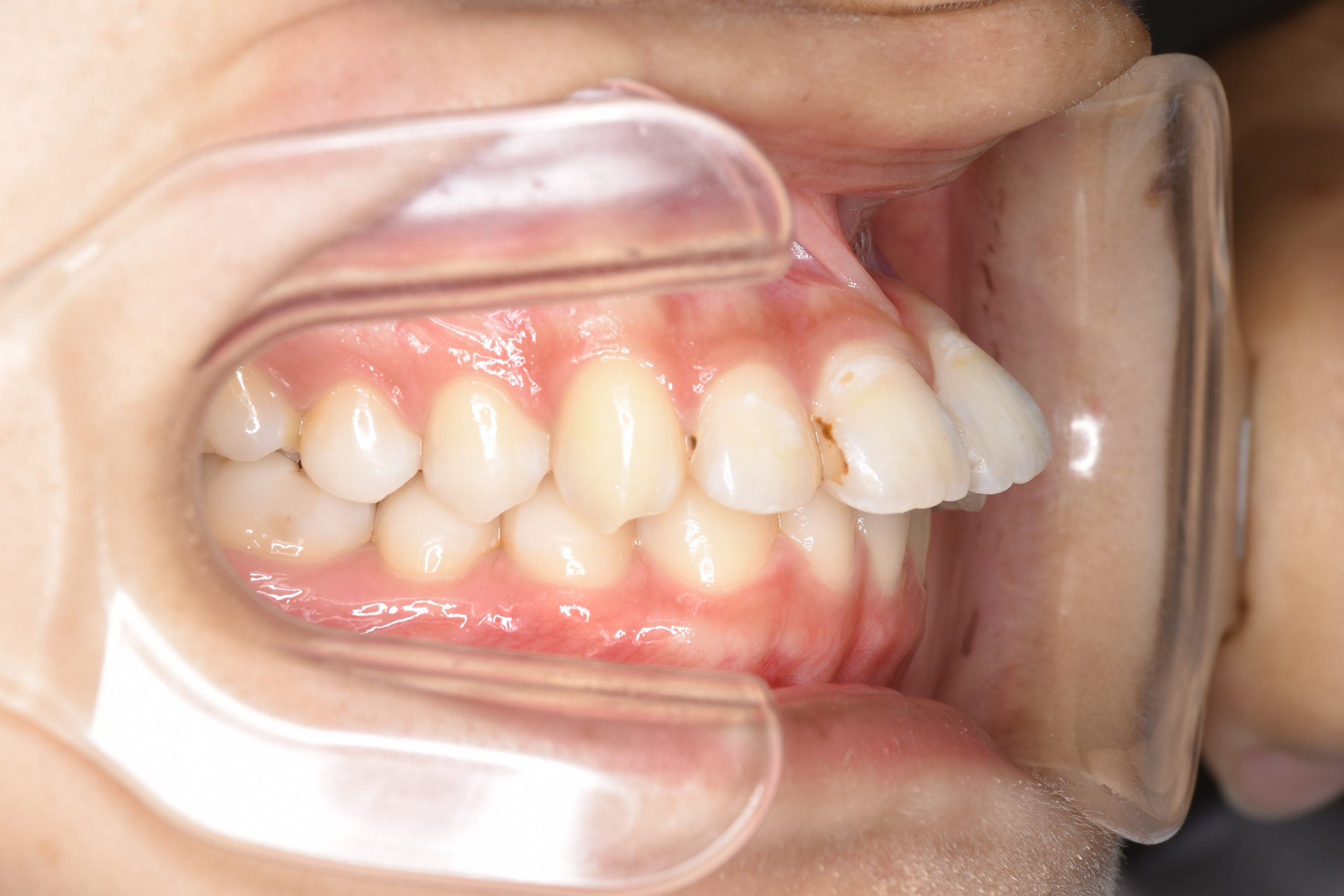 全顎ワイヤー矯正　症例_182