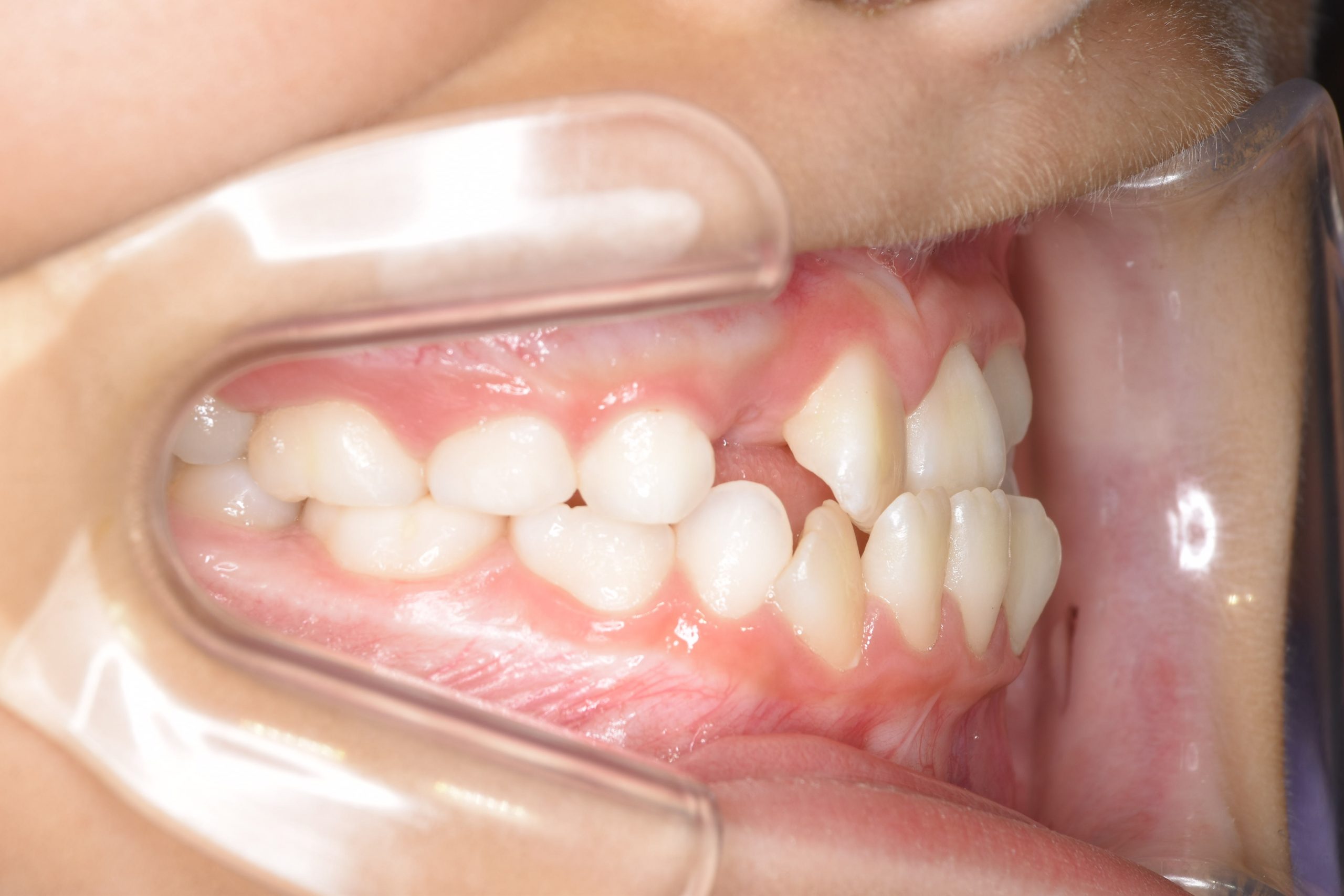 全顎ワイヤー矯正　症例_68