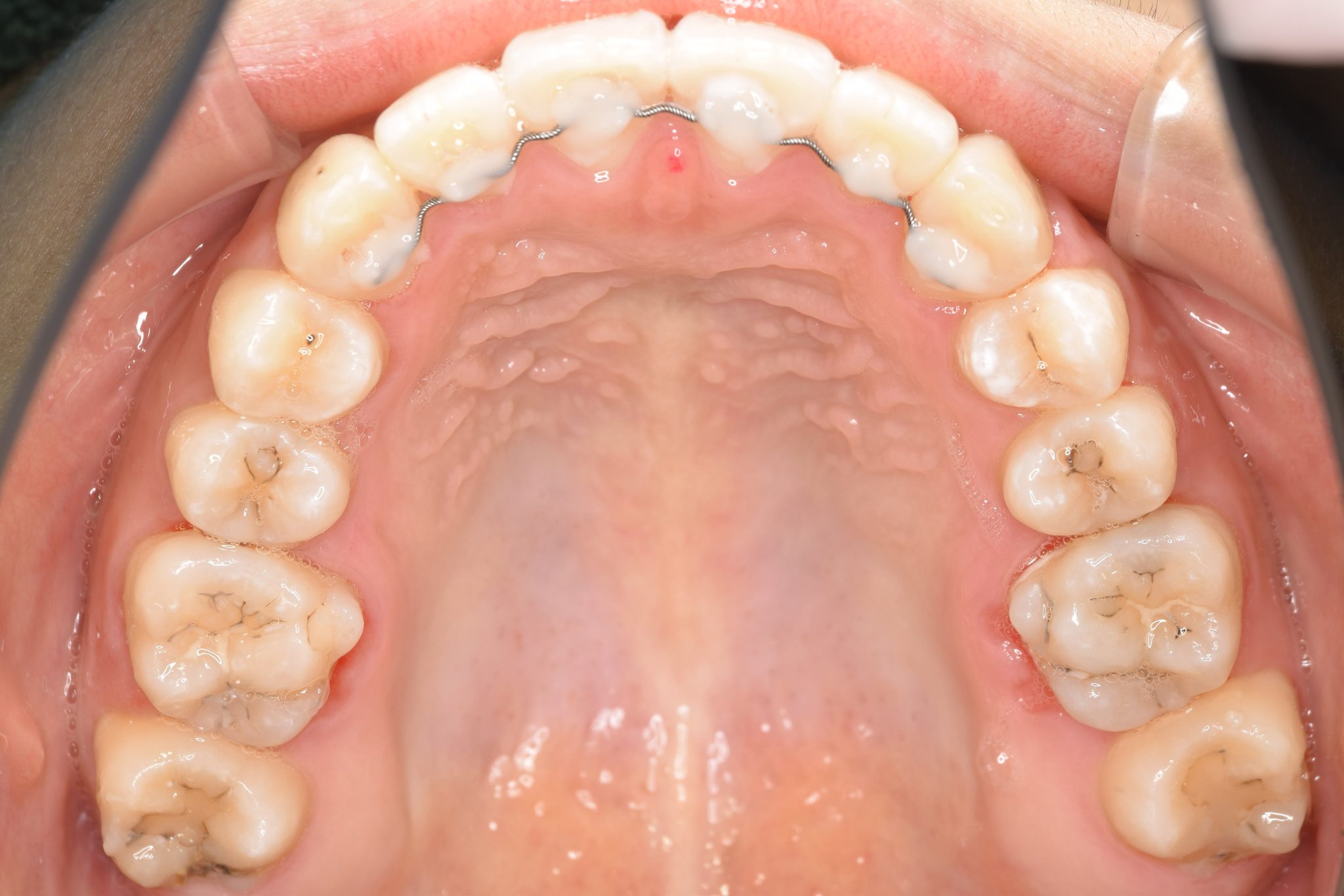 全顎ワイヤー矯正　症例_29