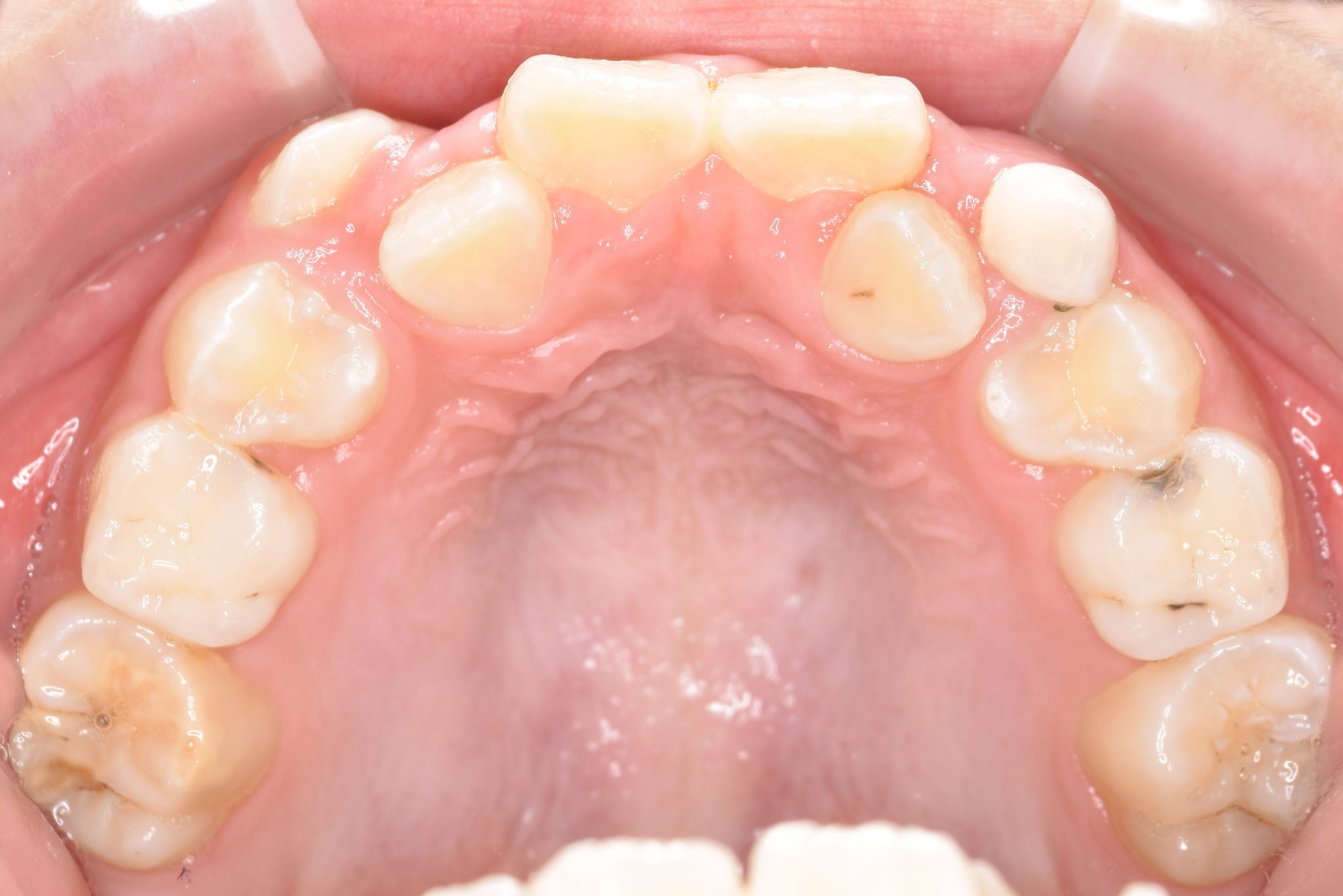 全顎ワイヤー矯正　症例_139