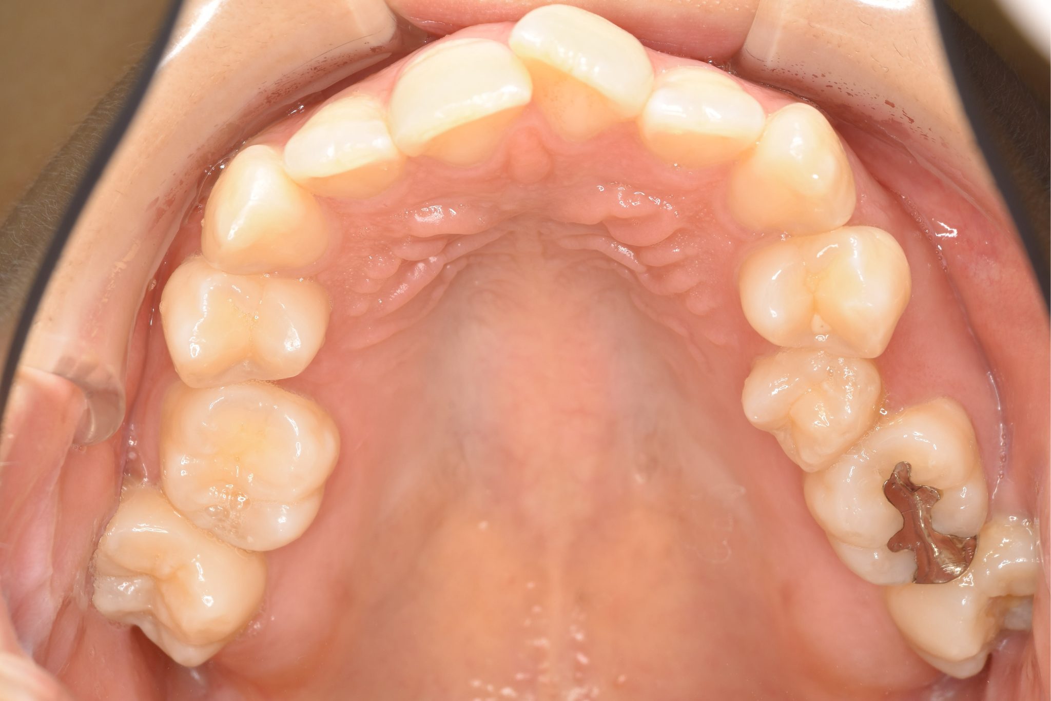 全顎ワイヤー矯正　症例_200