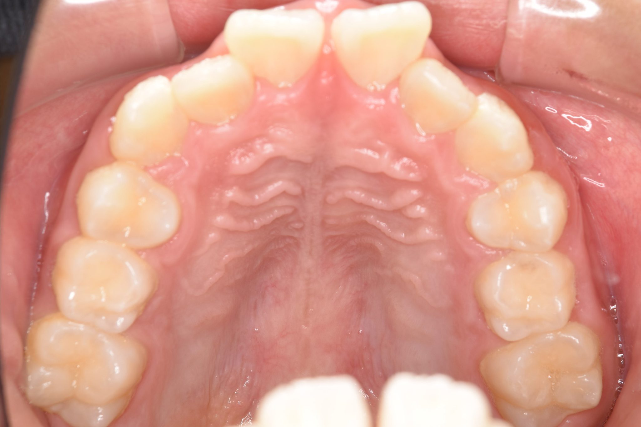 全顎ワイヤー矯正　症例_218