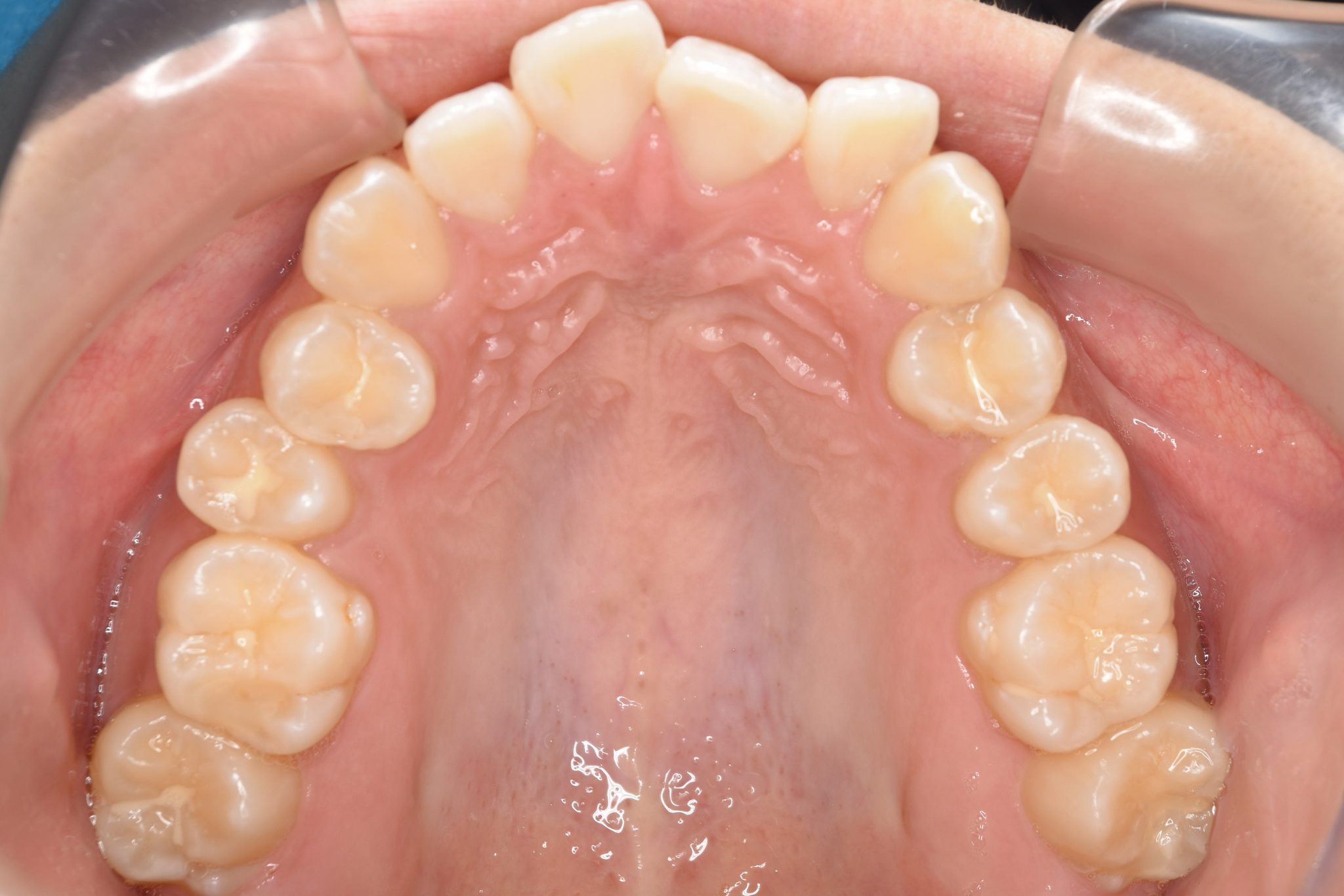 全顎ワイヤー矯正　症例_839