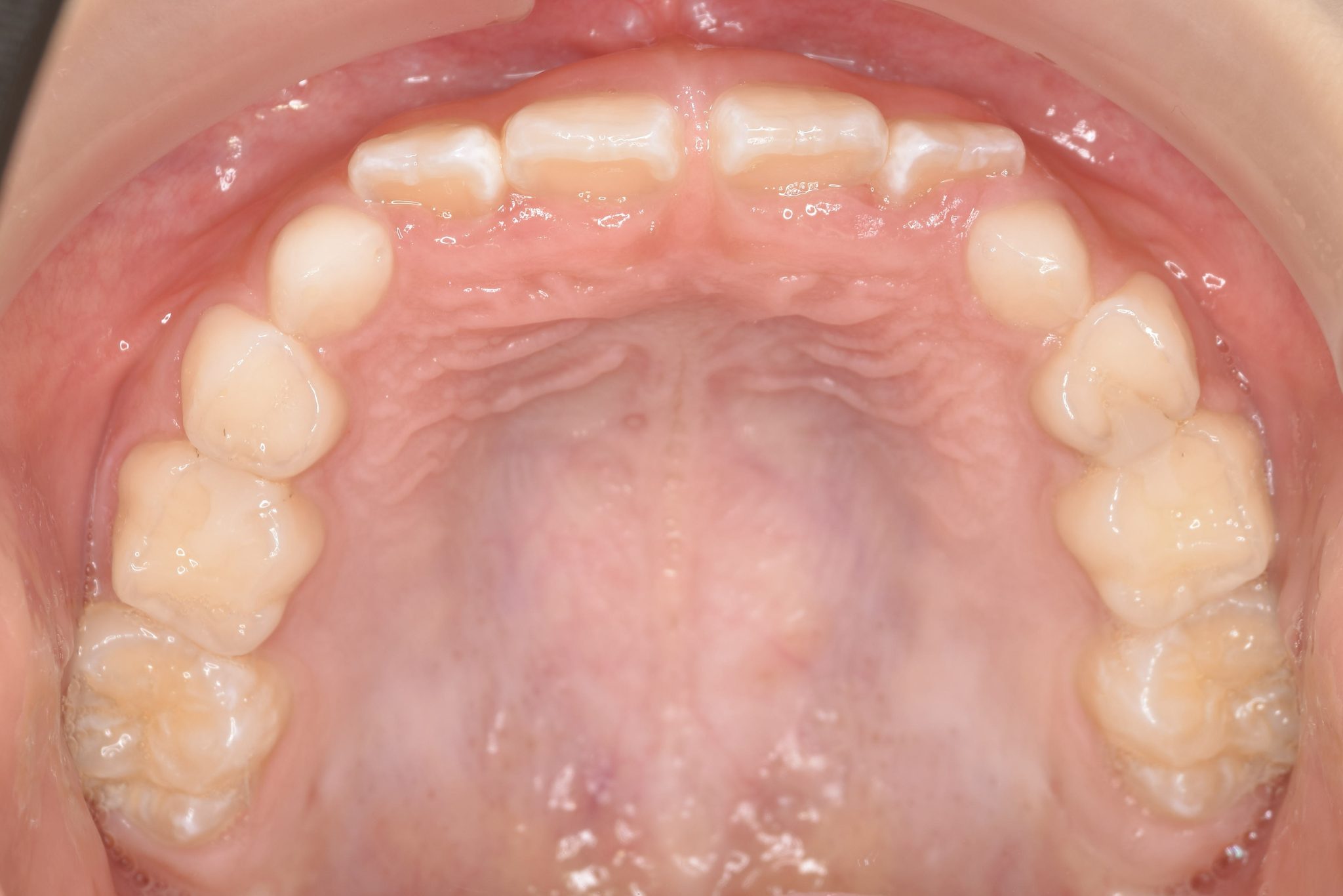 全顎ワイヤー矯正　症例_858