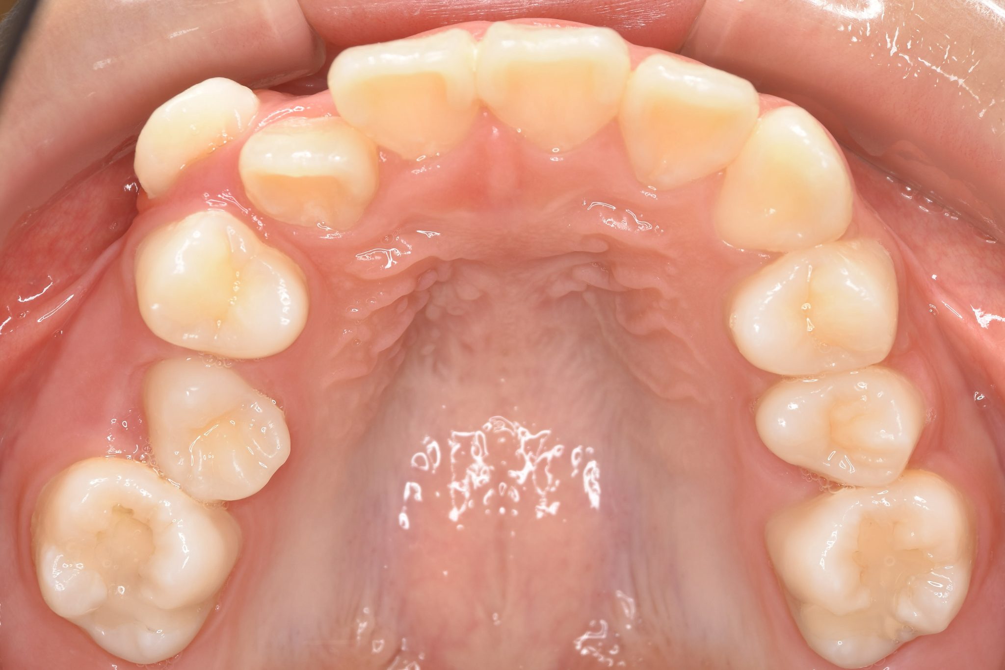 全顎ワイヤー矯正　症例_1324