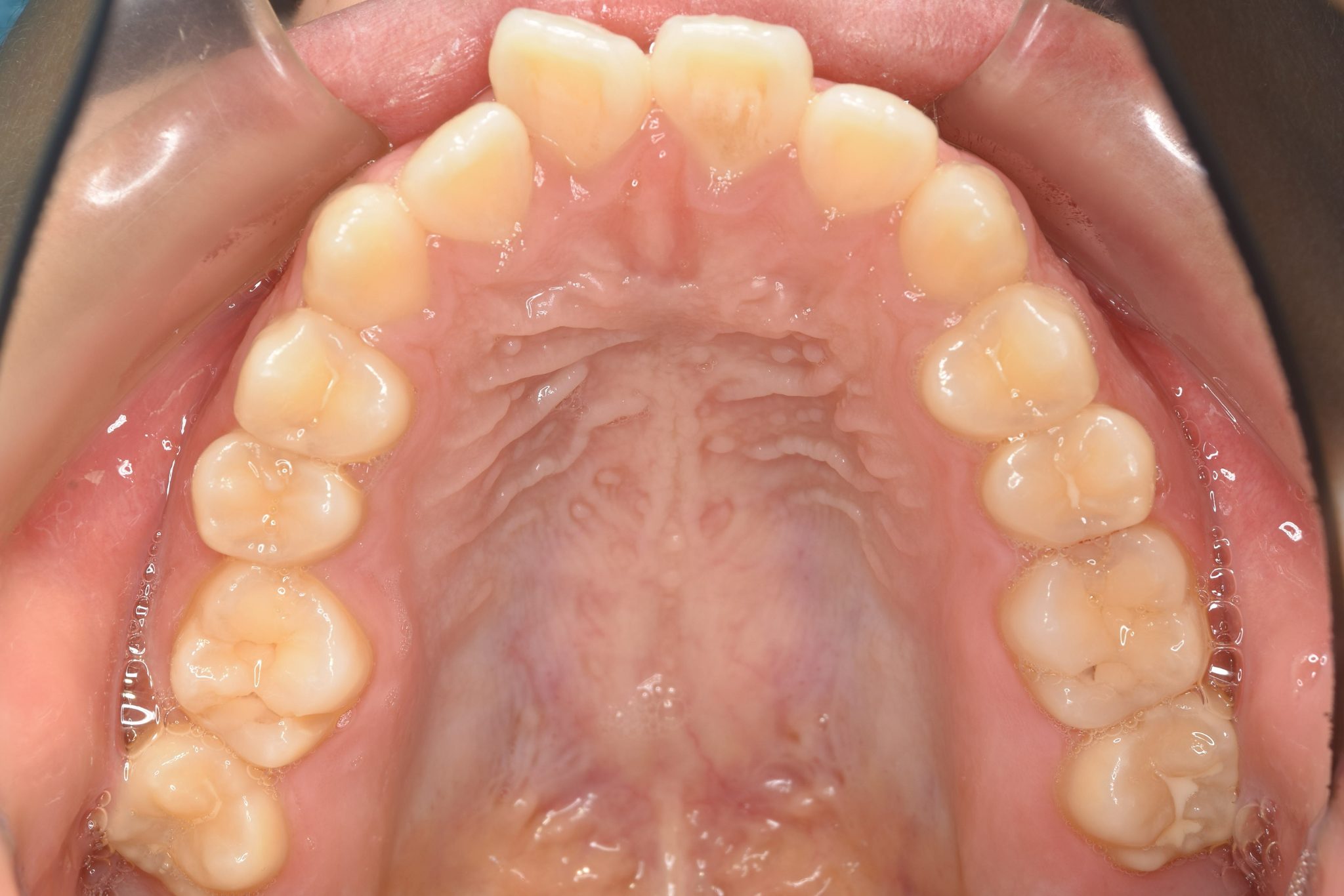 全顎ワイヤー矯正　症例_1409
