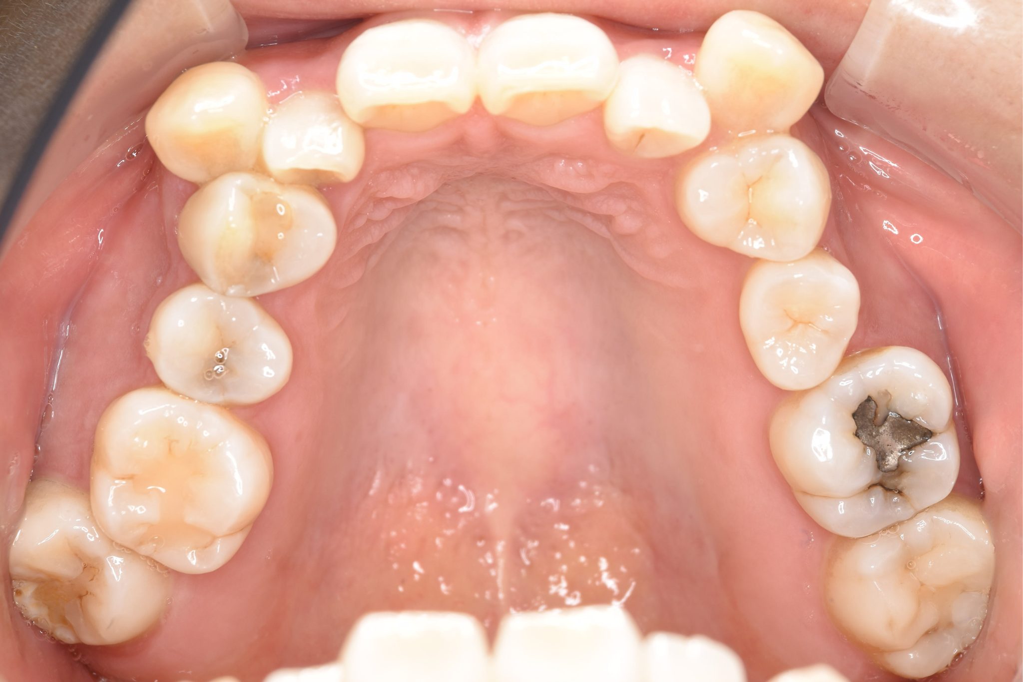 全顎ワイヤー矯正　症例_141