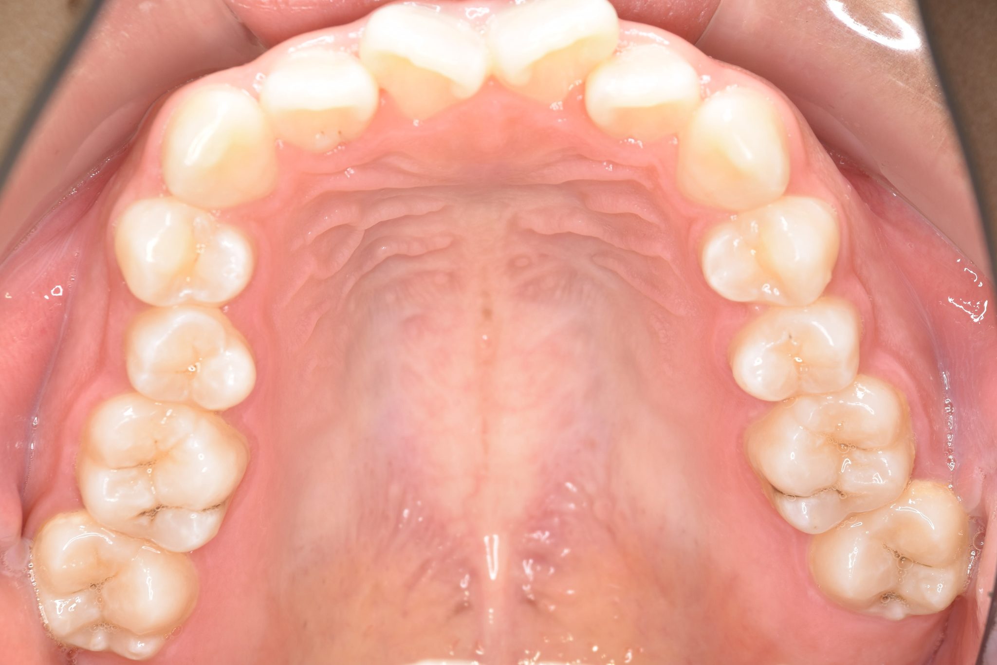全顎ワイヤー矯正　症例_148