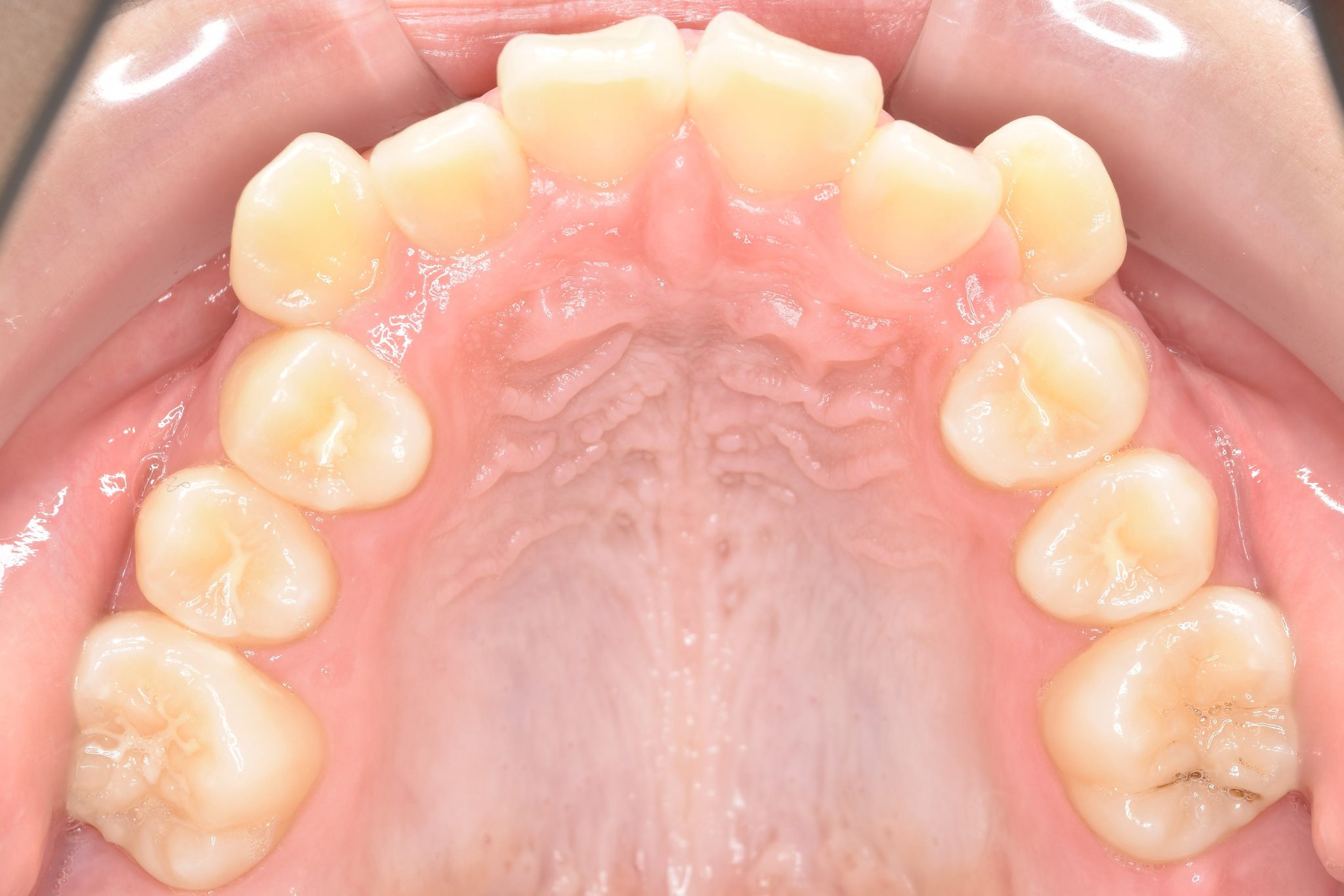 全顎ワイヤー矯正　症例_154