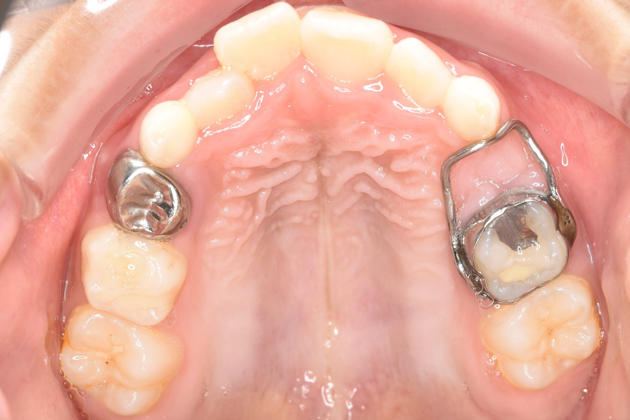 全顎ワイヤー矯正　症例_169