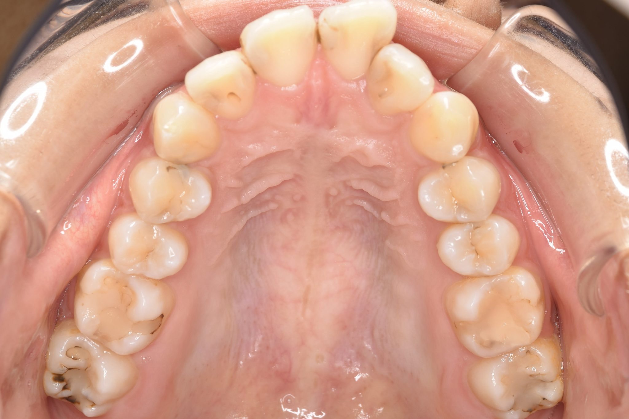 全顎ワイヤー矯正　症例_182