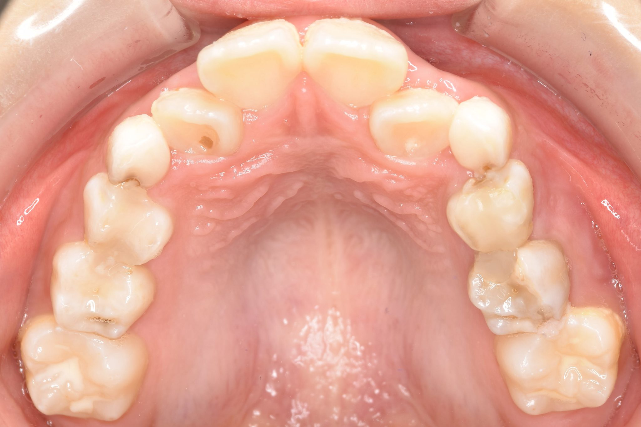 全顎ワイヤー矯正　症例_185