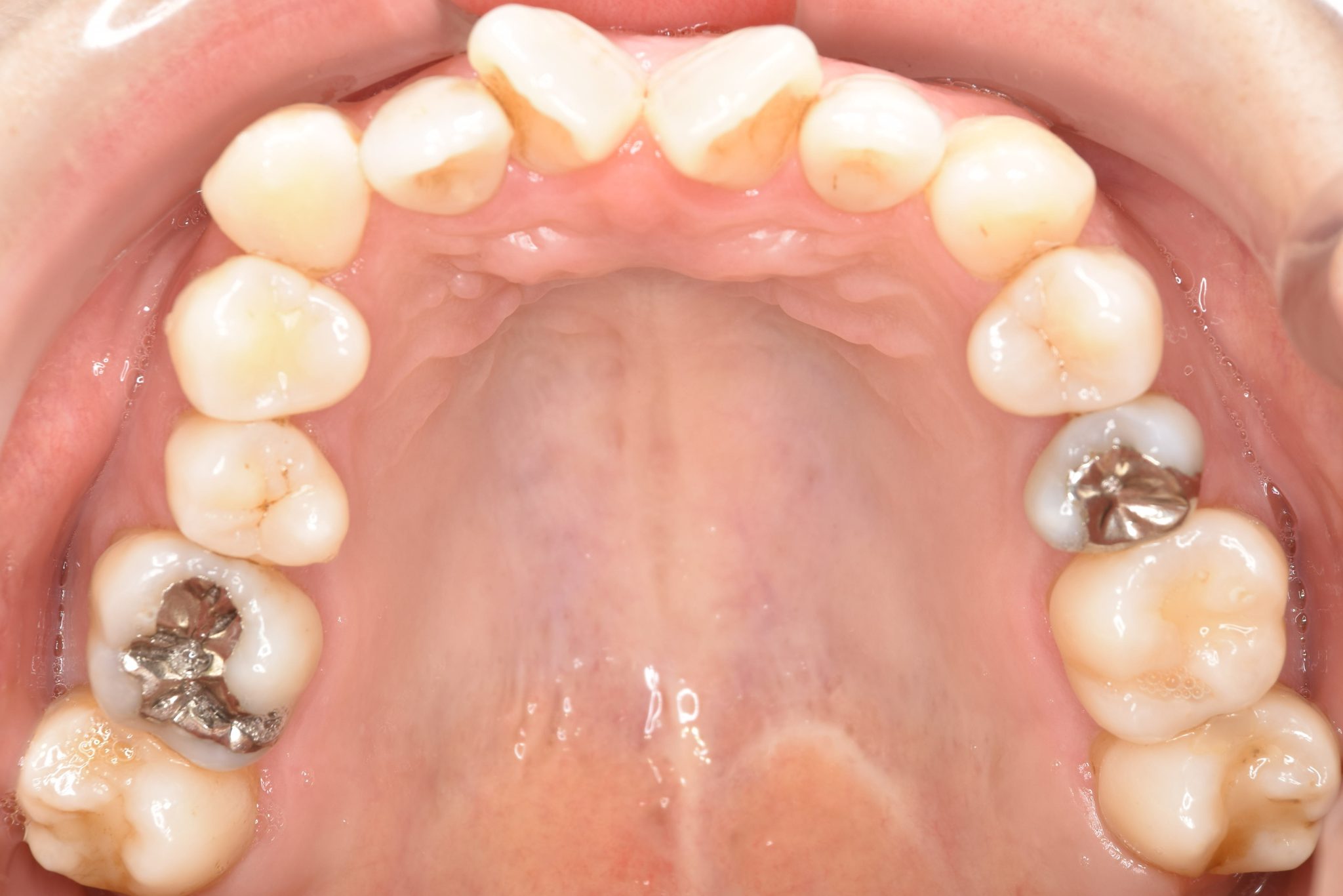 全顎ワイヤー矯正　症例_138