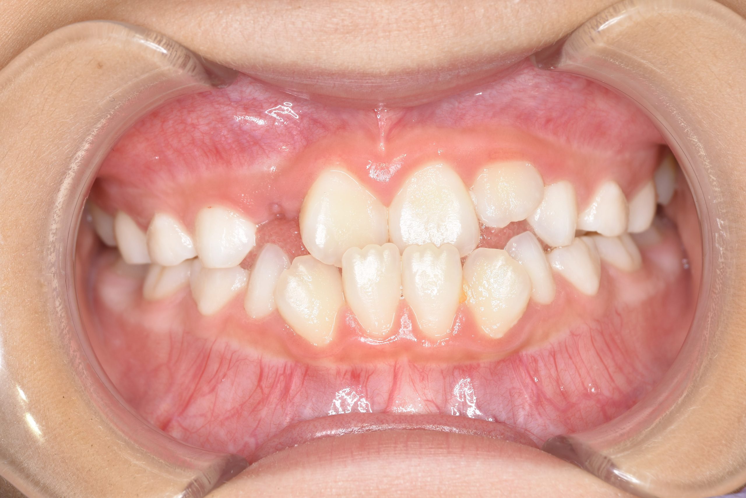 全顎ワイヤー矯正　症例_68