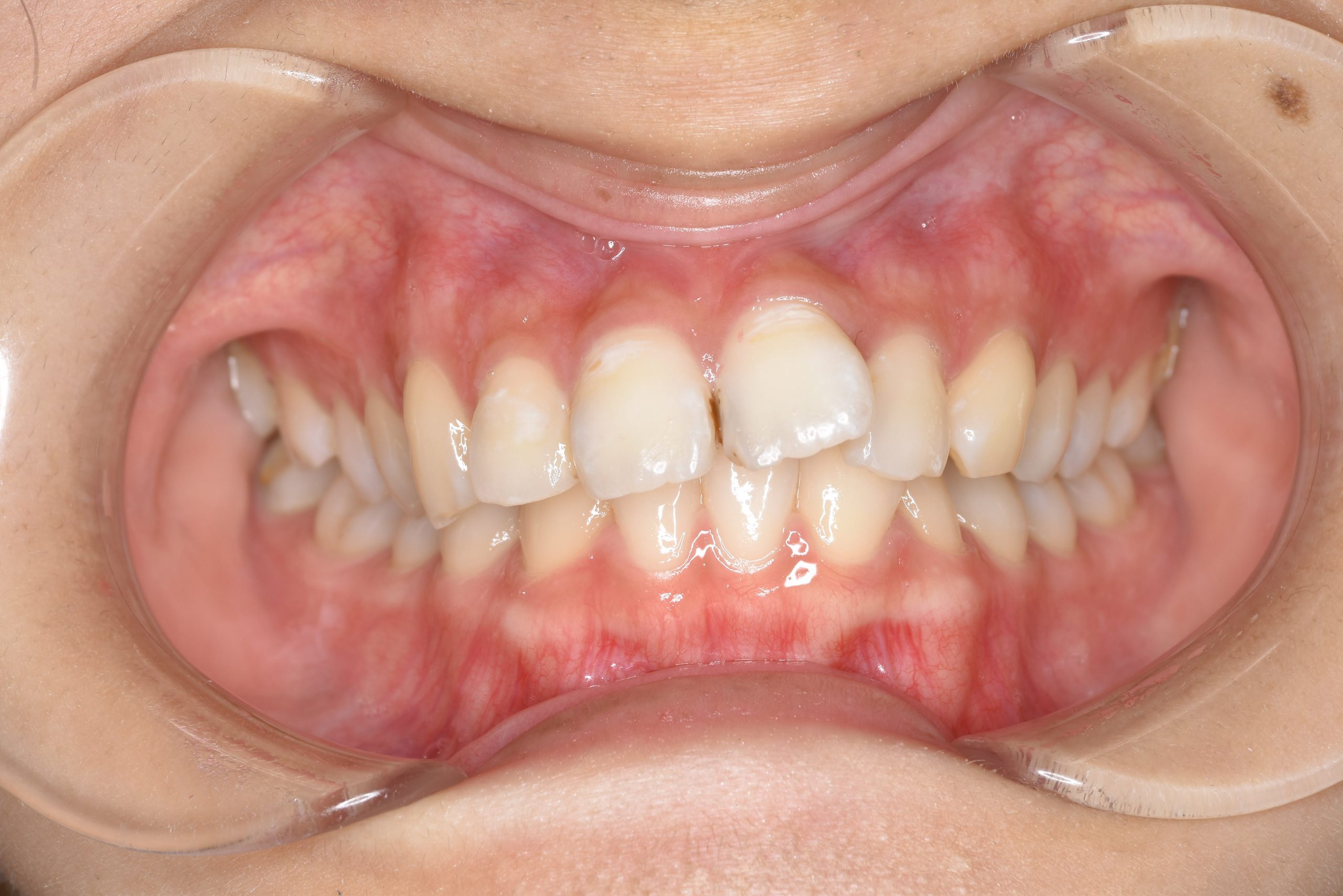 全顎ワイヤー矯正　症例_182