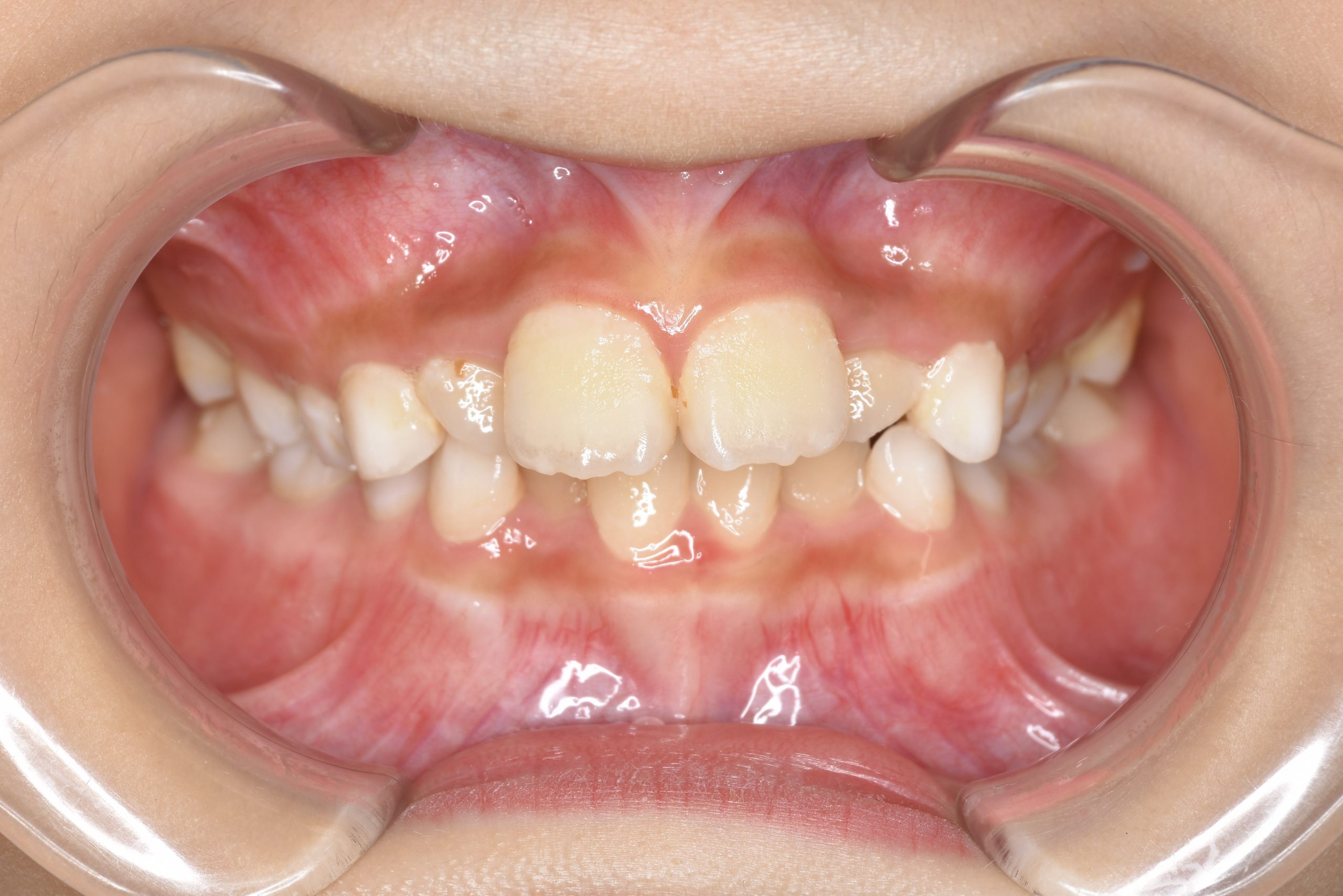 全顎ワイヤー矯正　症例_185