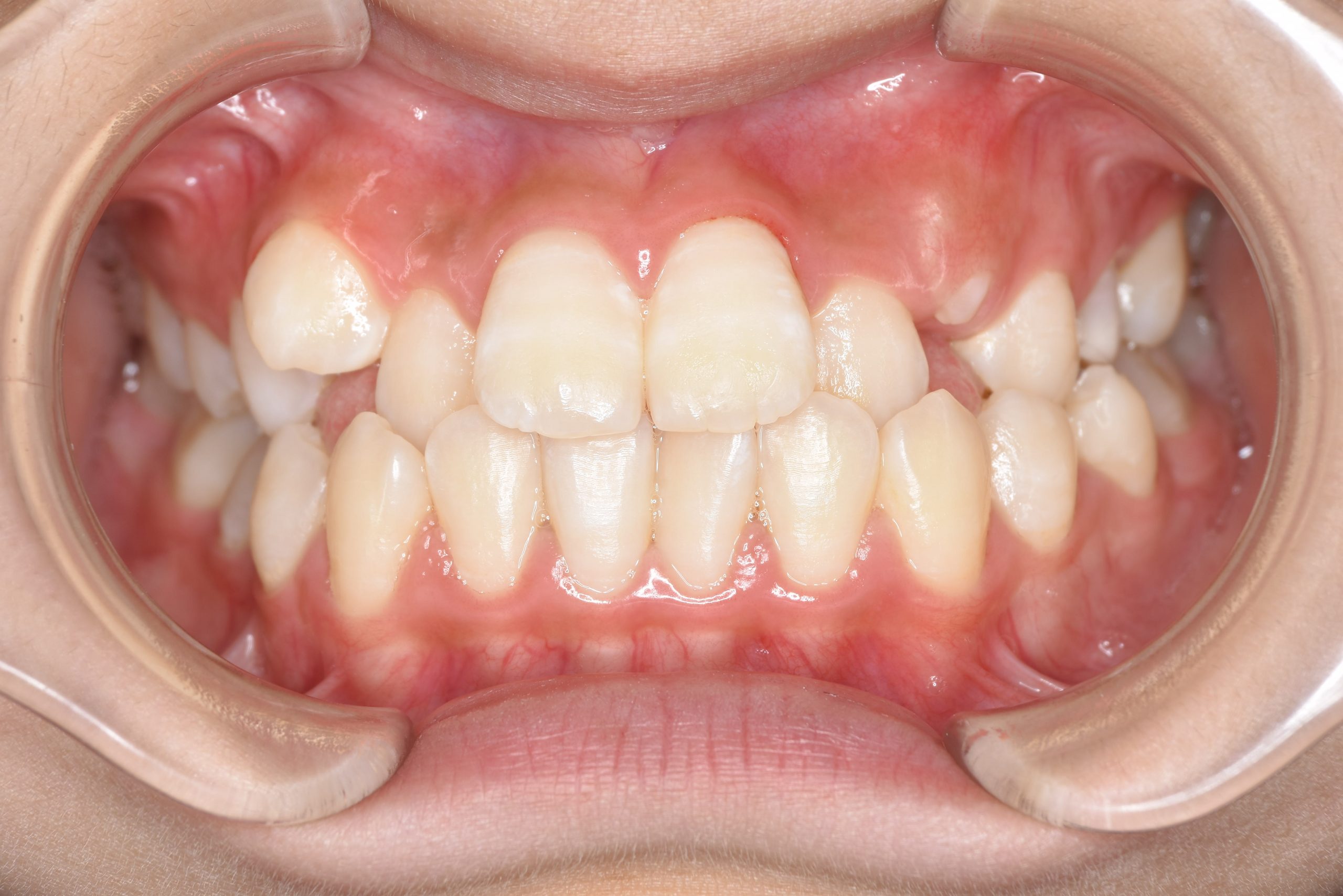 全顎ワイヤー矯正　症例_198