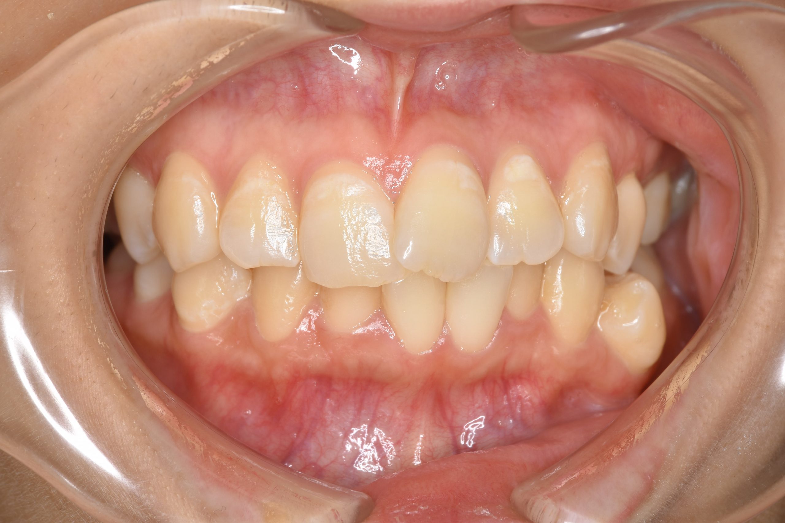 全顎ワイヤー矯正　症例_200