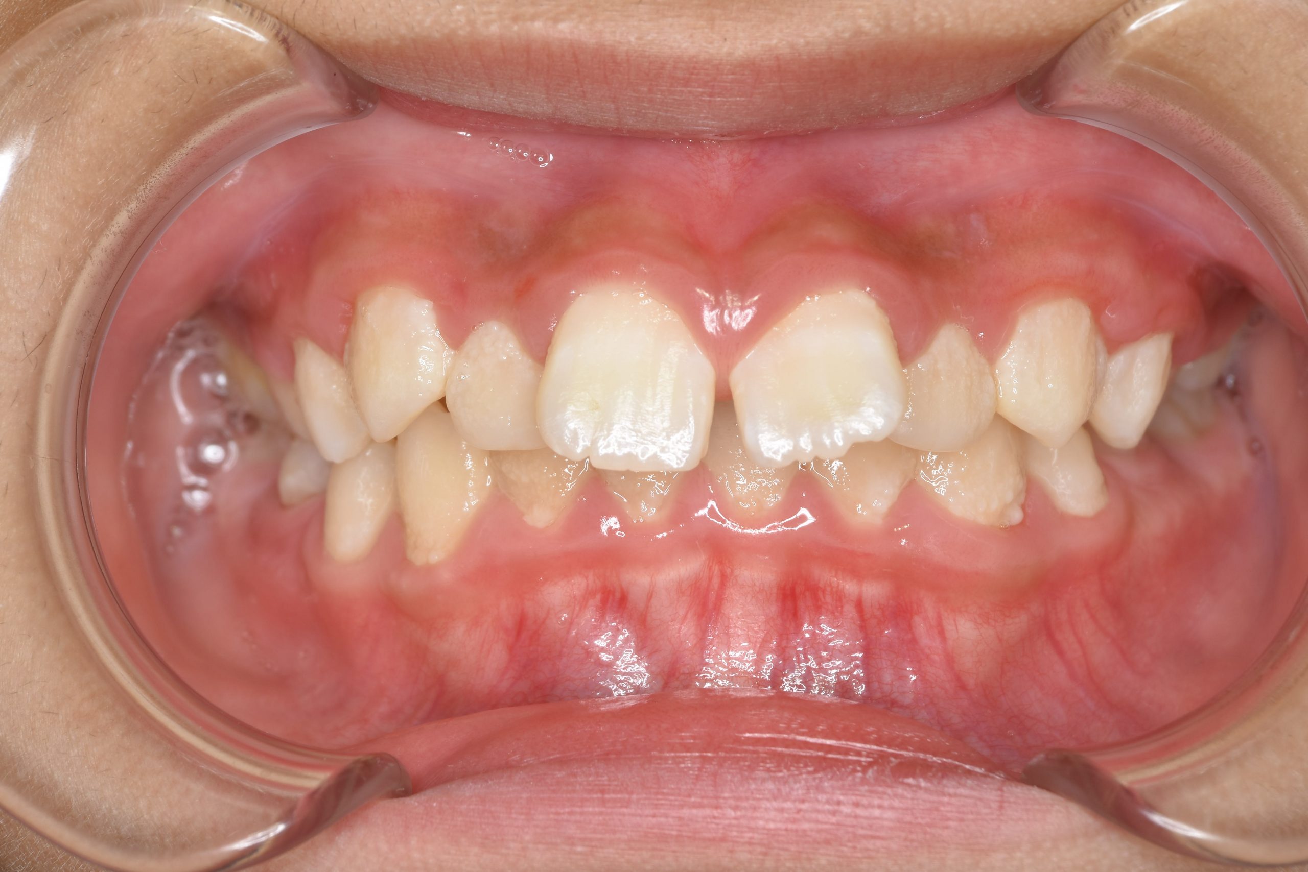 全顎ワイヤー矯正　症例_218