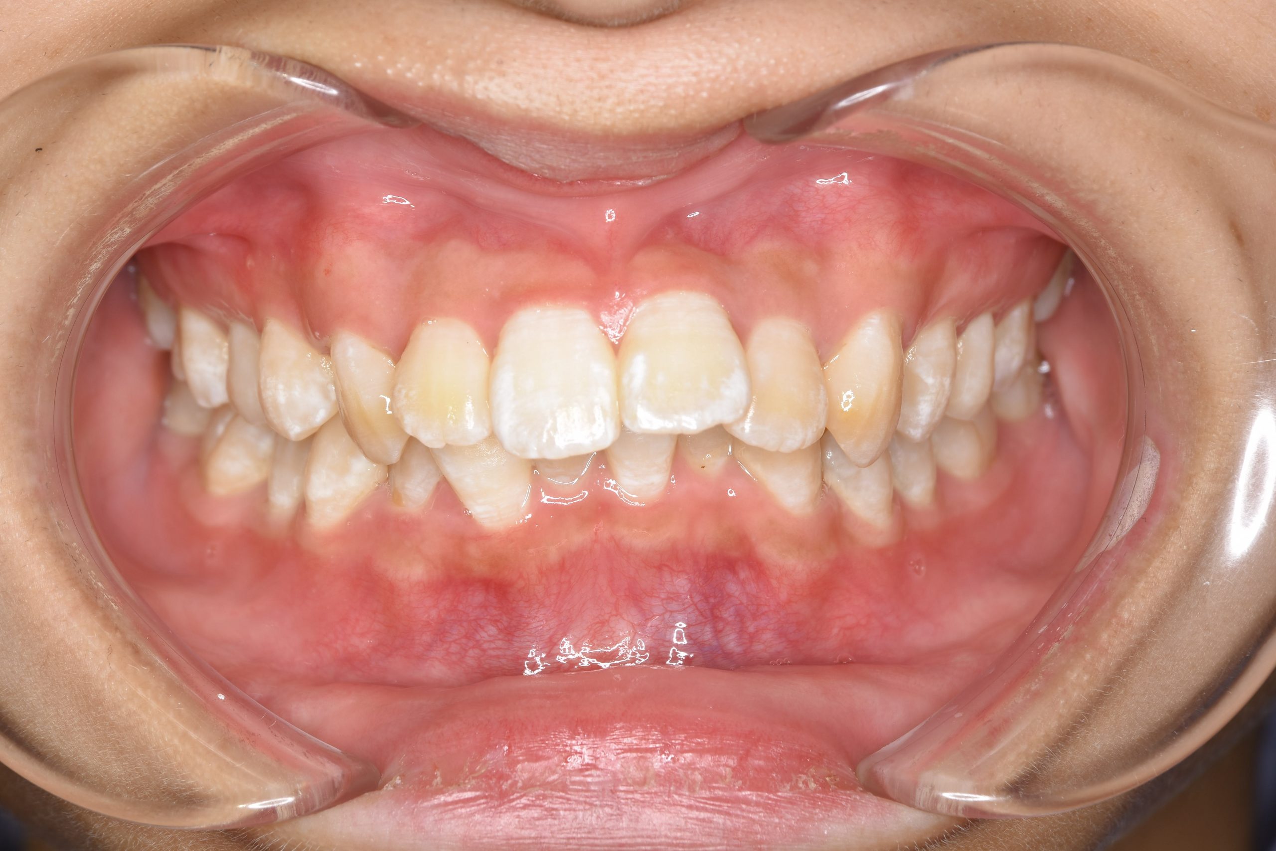 全顎ワイヤー矯正　症例_252