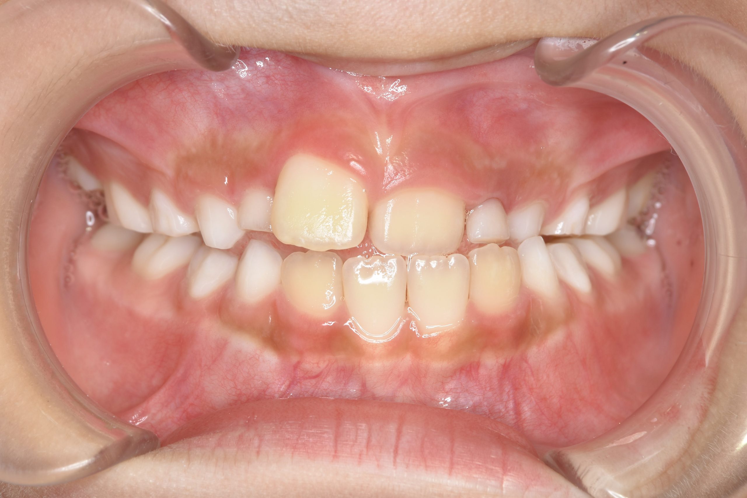 全顎ワイヤー矯正　症例_261