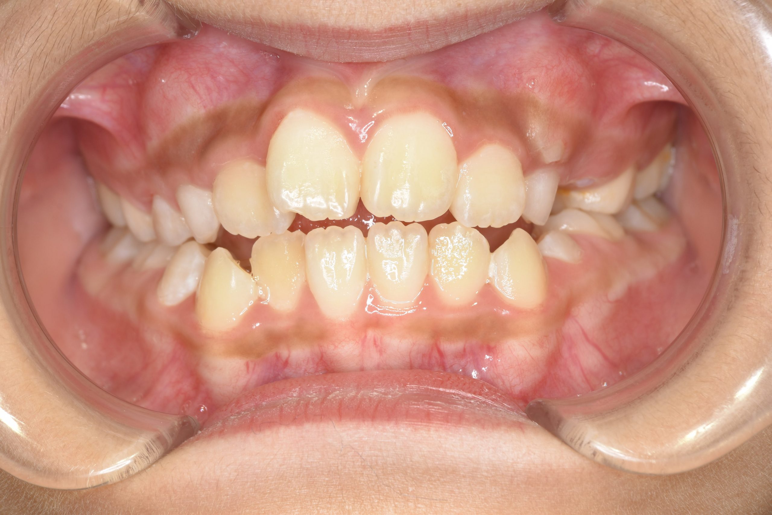 全顎ワイヤー矯正　症例_267