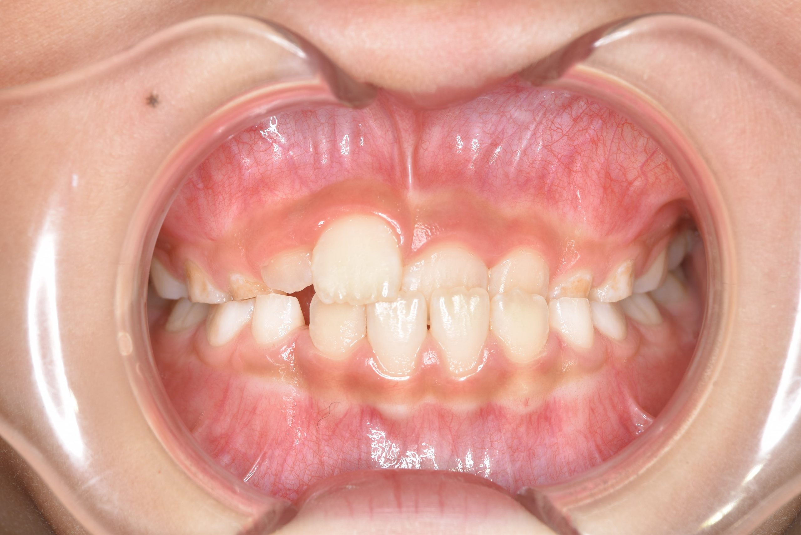 全顎ワイヤー矯正　症例_108