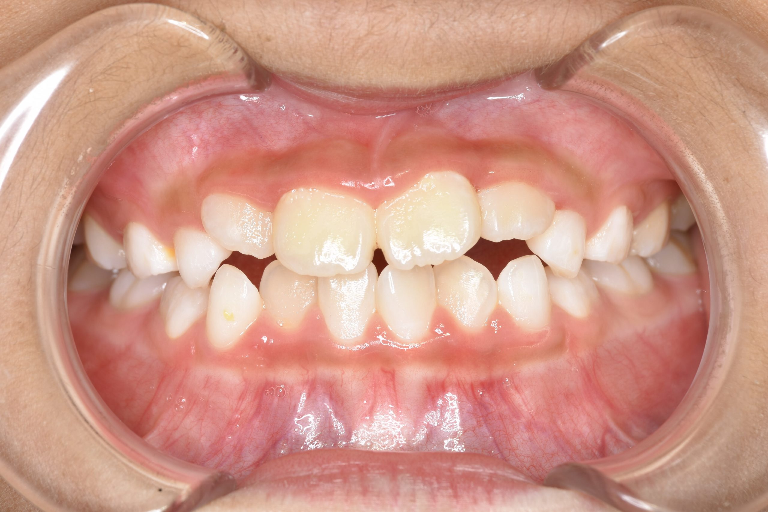 全顎ワイヤー矯正　症例_276