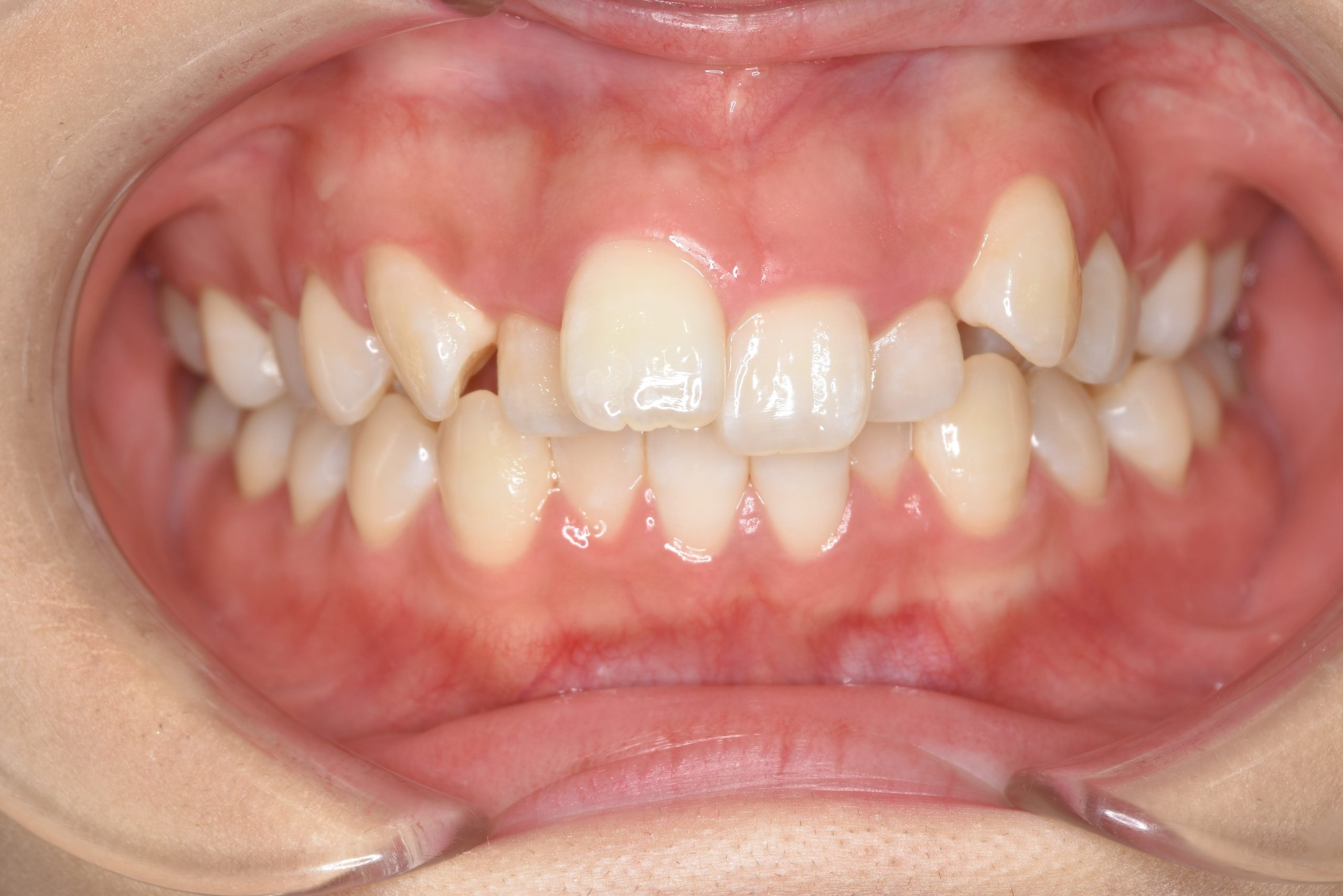 全顎ワイヤー矯正　症例_306